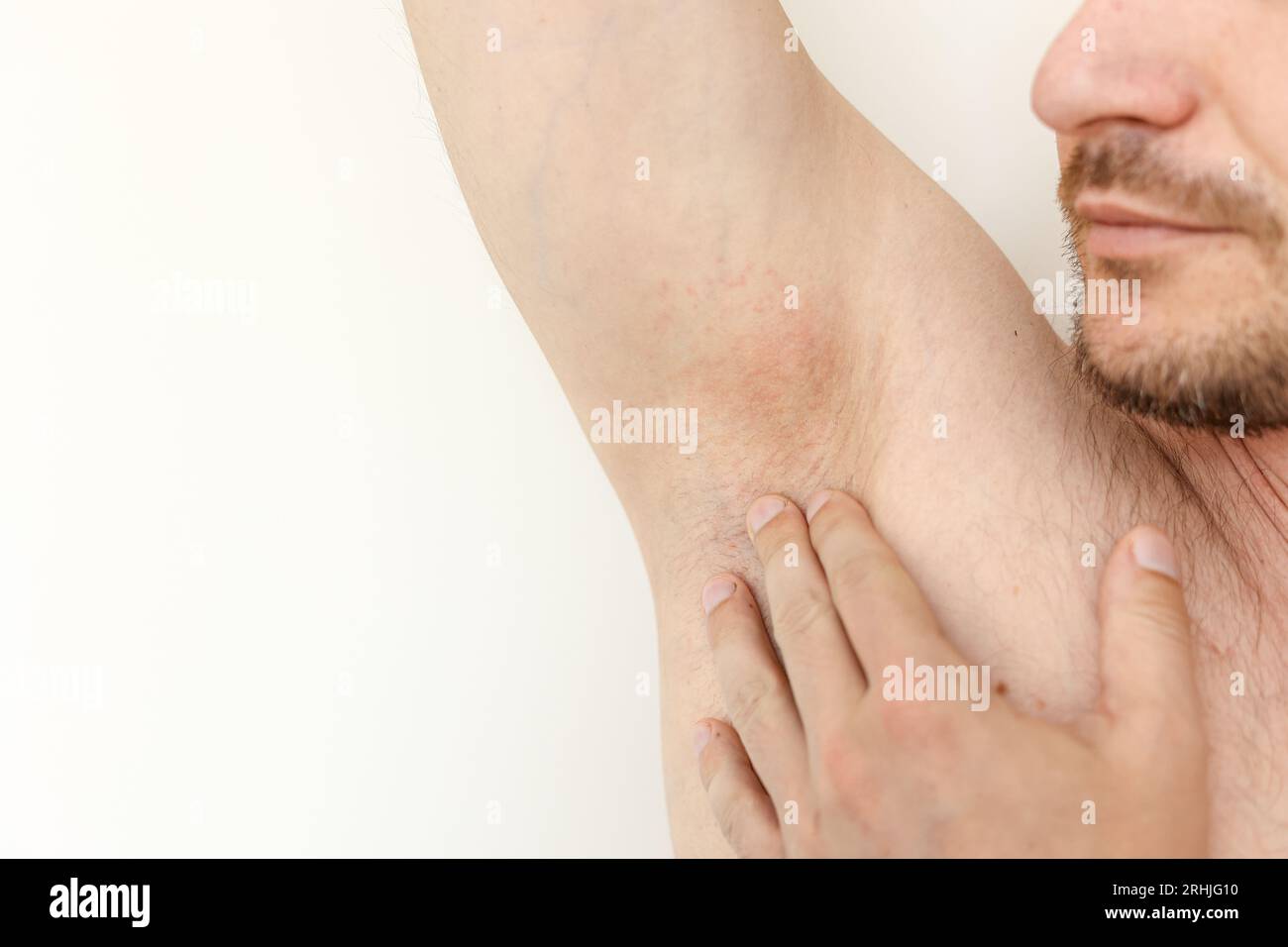 Young man shows irritation on the sensitive skin after using a razor ...