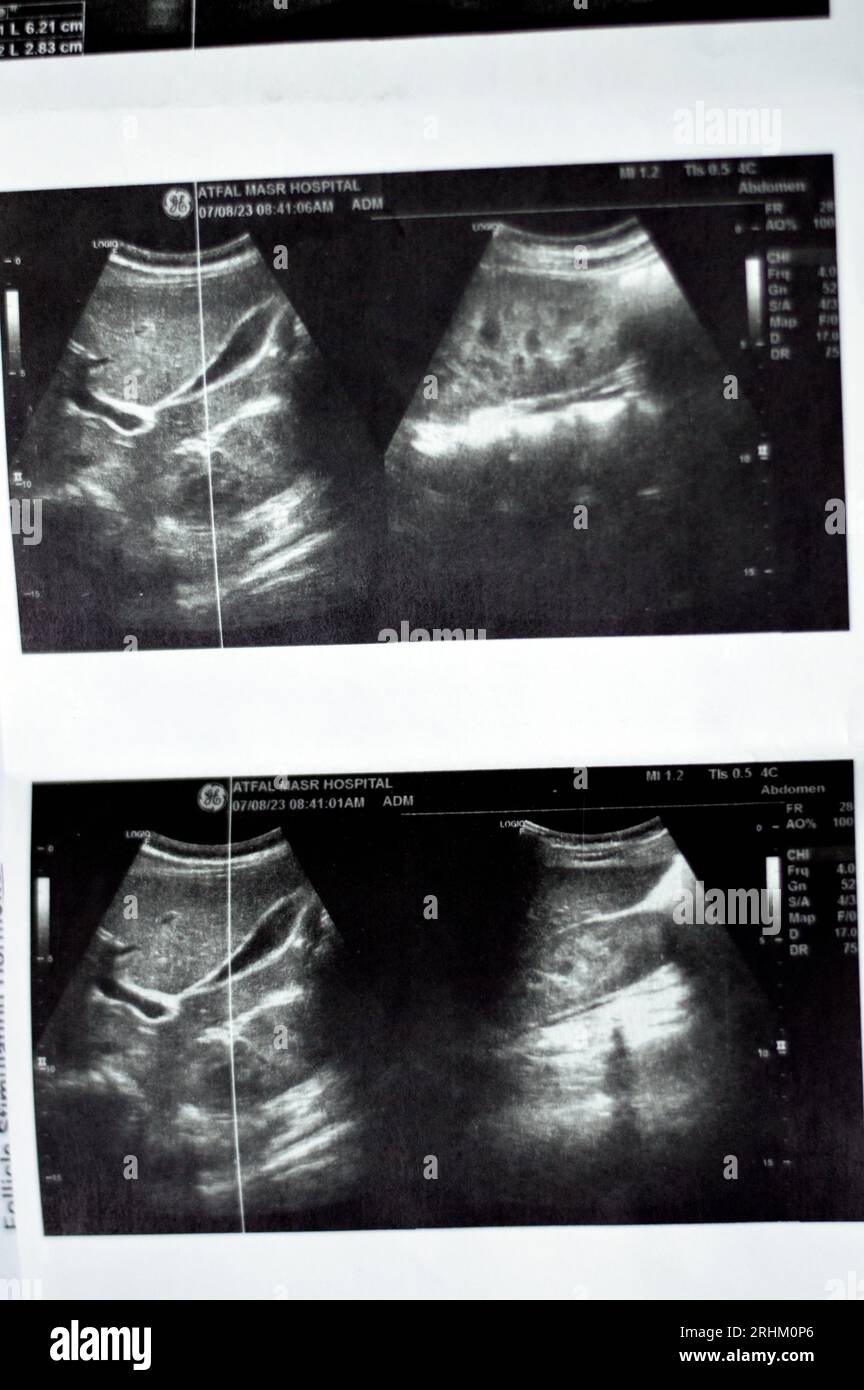 Cairo, Egypt, August 9 2023: Diagnostic pelviabdominal ultrasonography ...