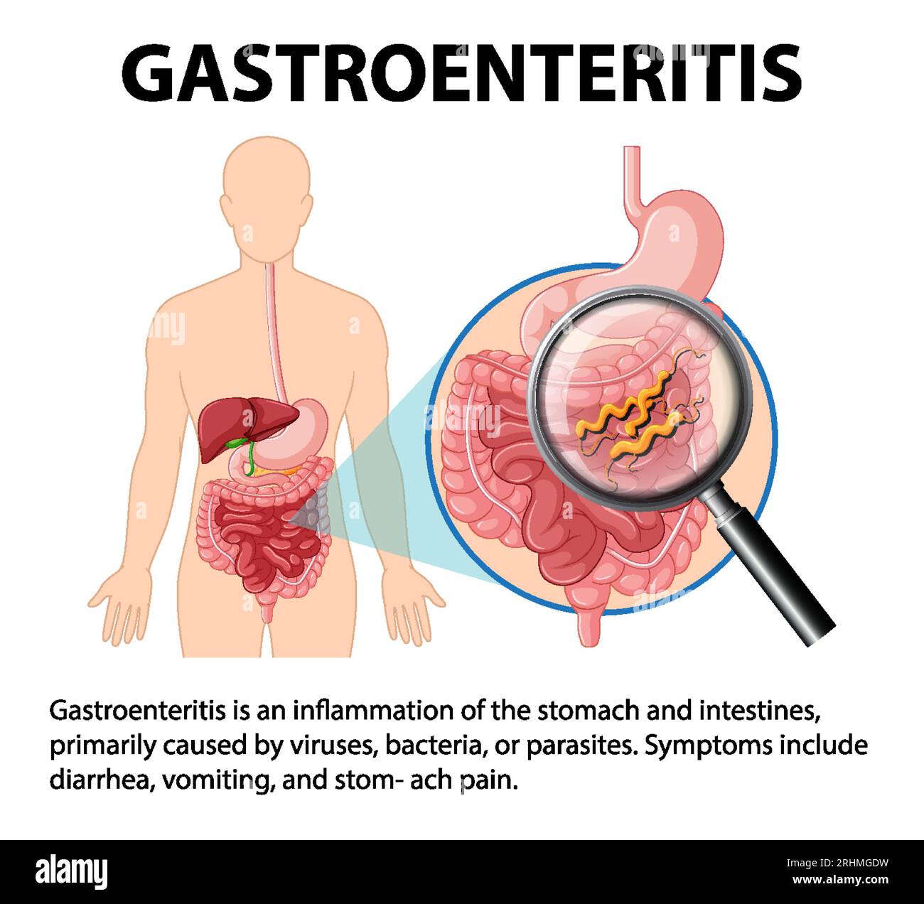 Gastroenteritis Symptoms