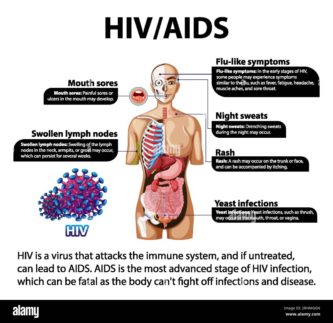 Illustrated Infographic Depicting The Impact Of HIV AIDS On The Body 