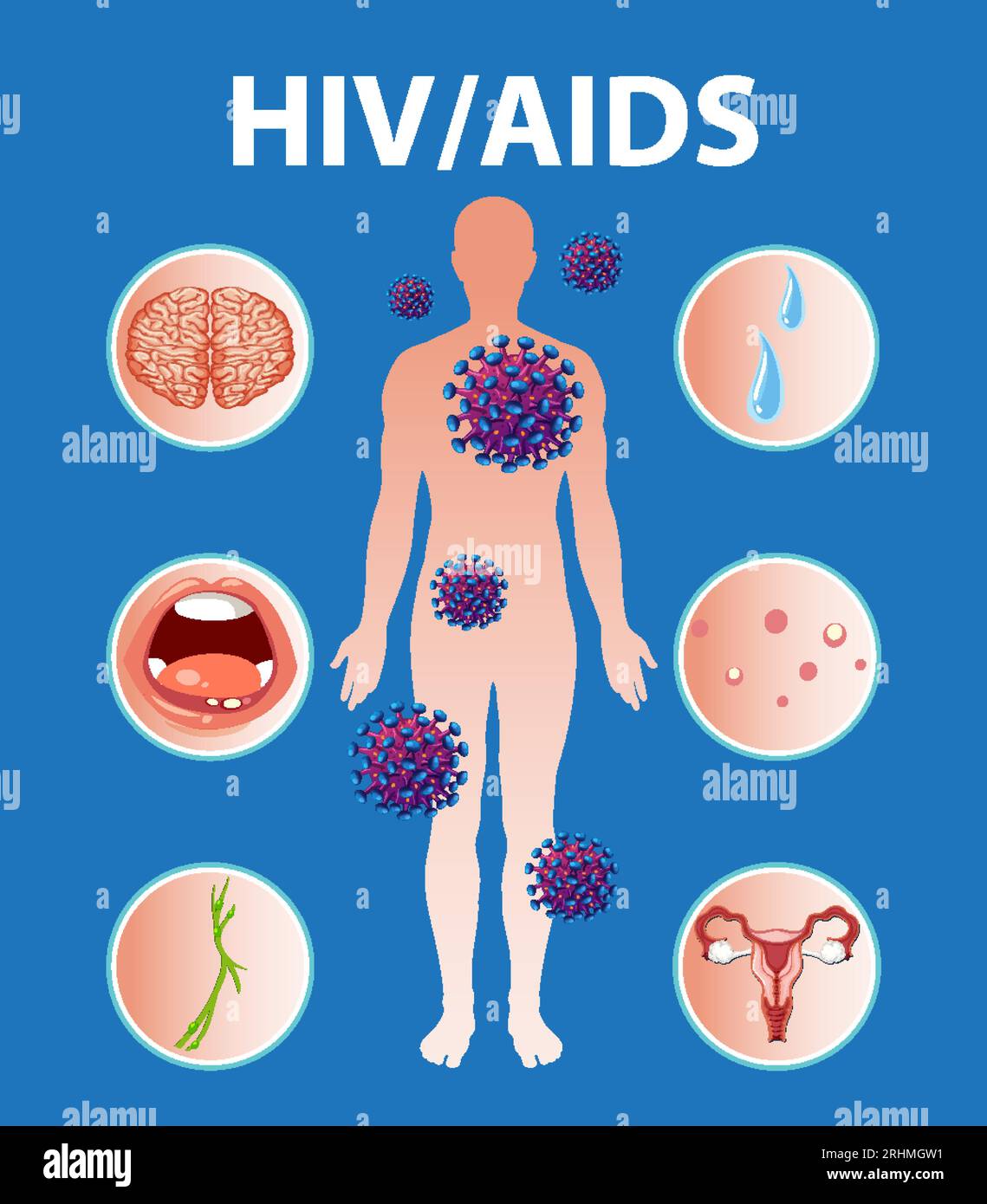 Illustration Depicting How HIV AIDS Virus Attacks Immune System And 