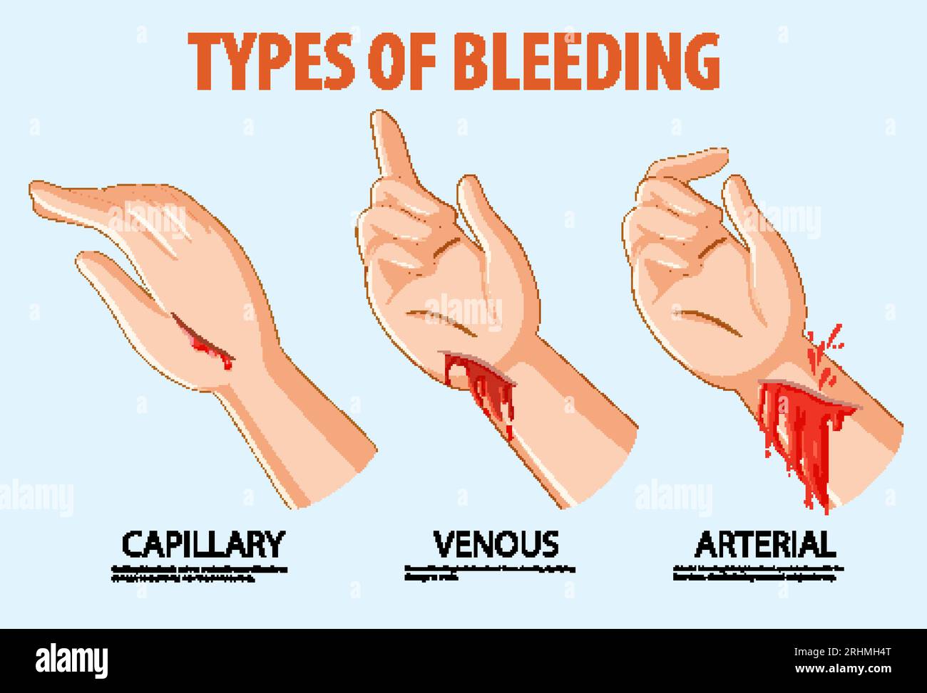Vector cartoon illustration showing various bleeding types in hand ...