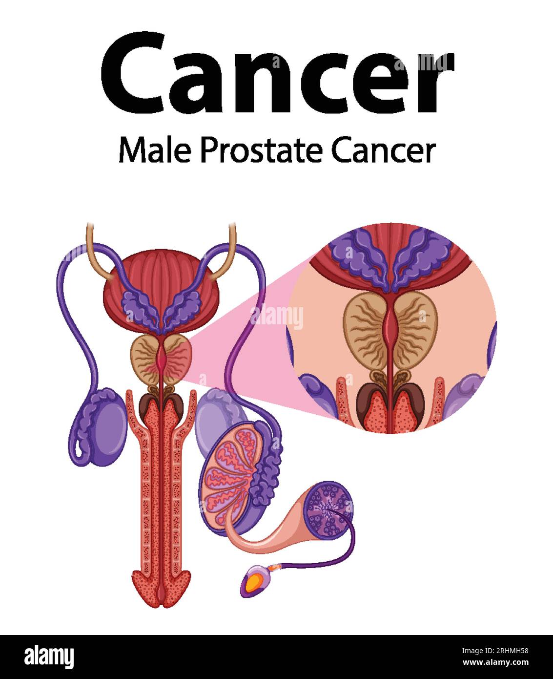 Infographic illustrating male prostate cancer and abnormal cell growth ...