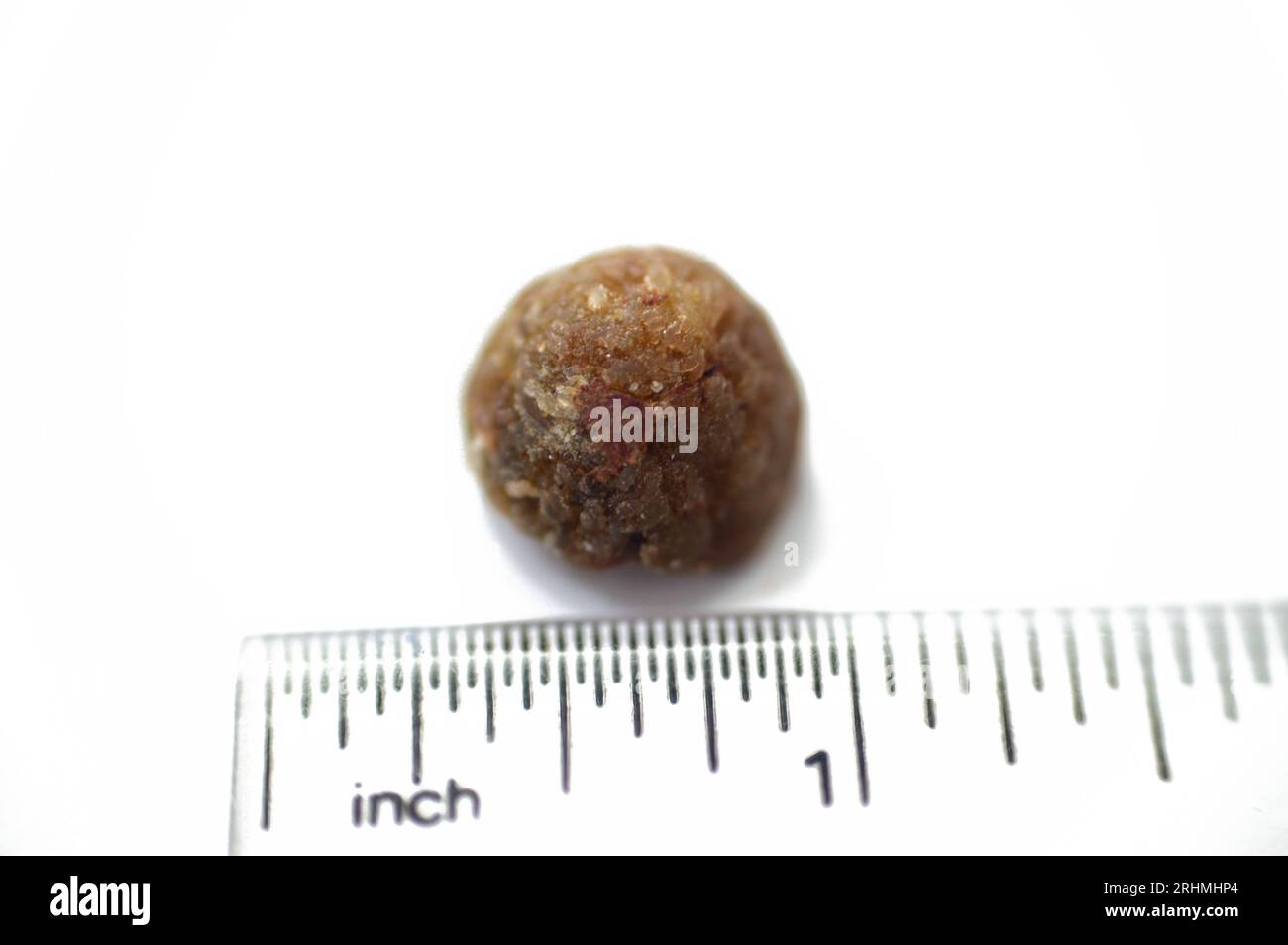 Large gallstone removed surgically after laparoscopic cholecystectomy, Gallstones are hardened deposits of digestive fluid that can form in gallbladde Stock Photo