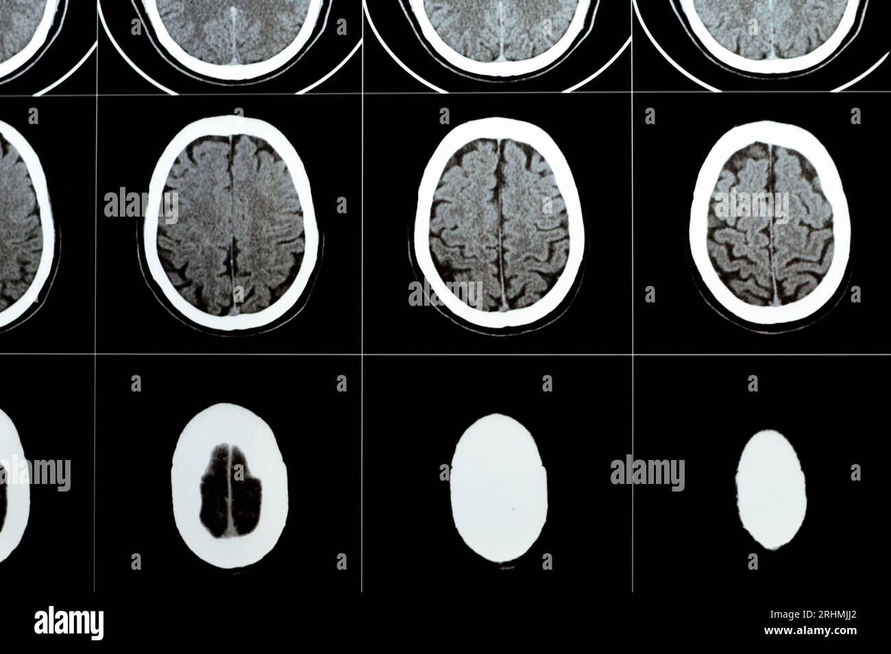 Multi slice CT scan of the brain showing Large brain stem and right centrum semiovale hematoma, normal posterior fossa structures, normal size of vent Stock Photo