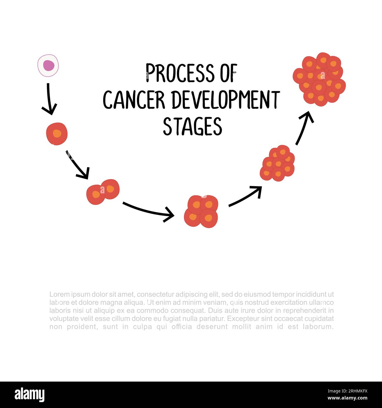 process of cancer development stages illustration isolated on white ...