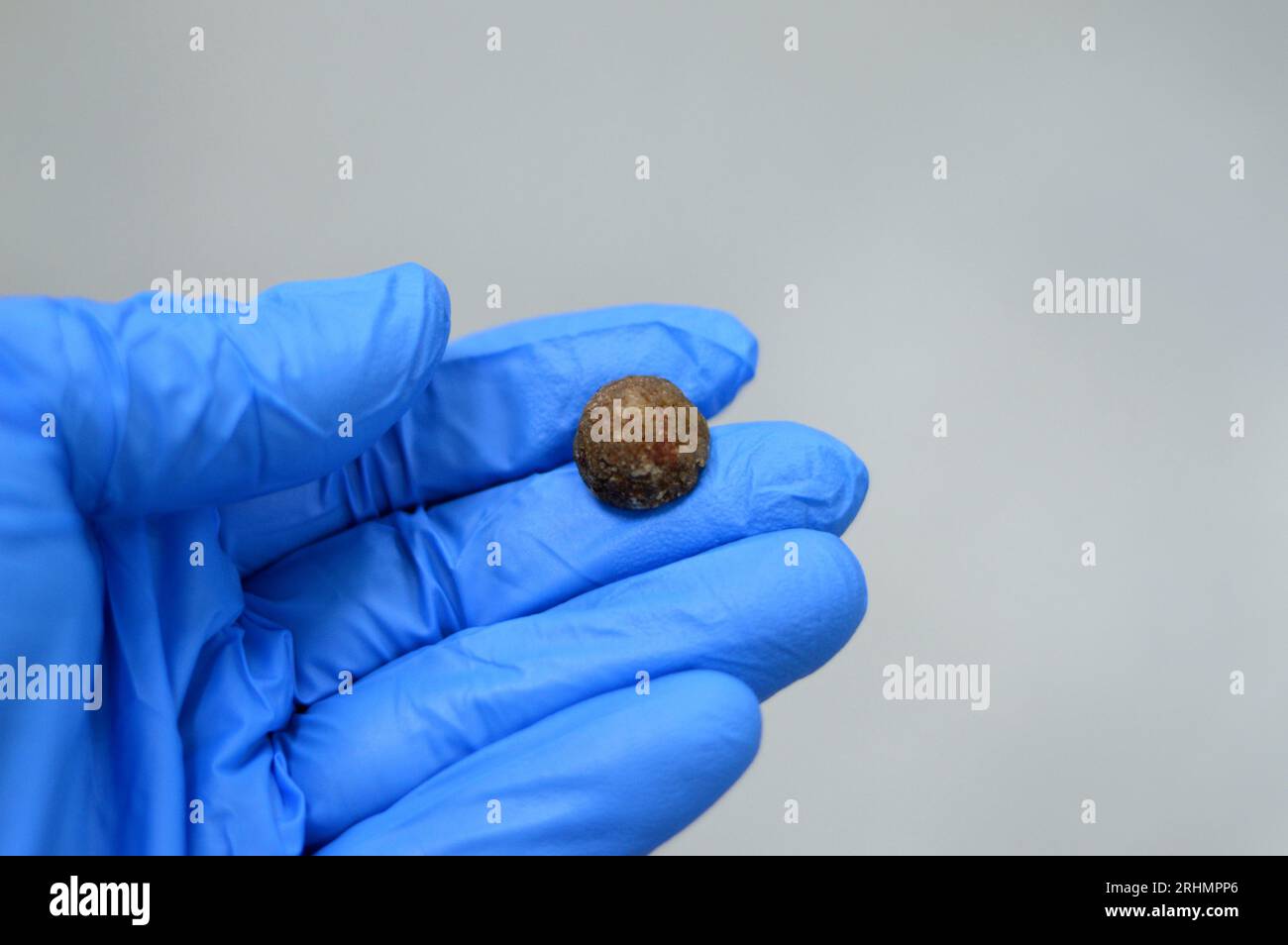 Large gallstone removed surgically after laparoscopic cholecystectomy