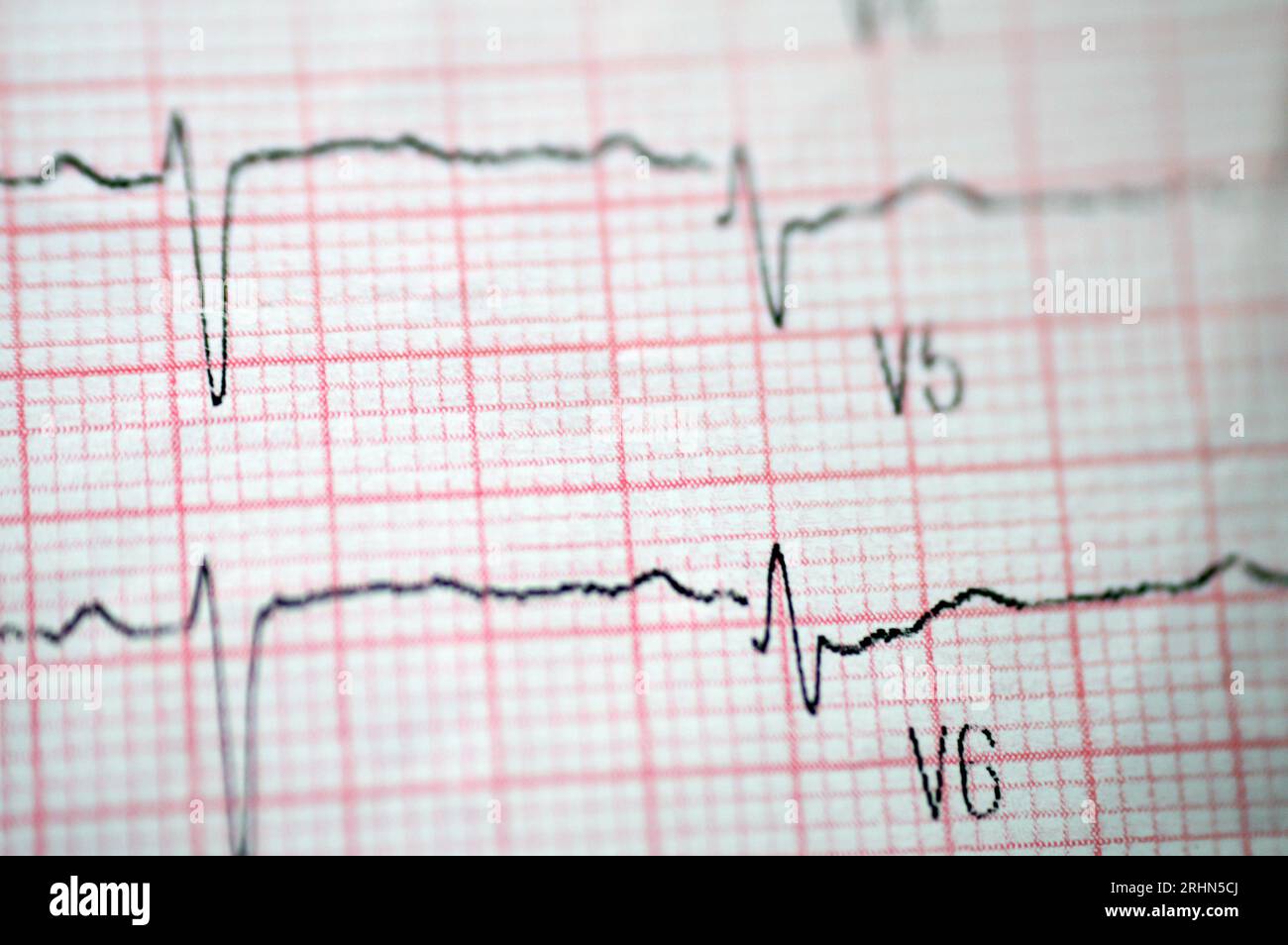 Ecg Abnormalities Chart Oficial Online | www.gbu-hamovniki.ru