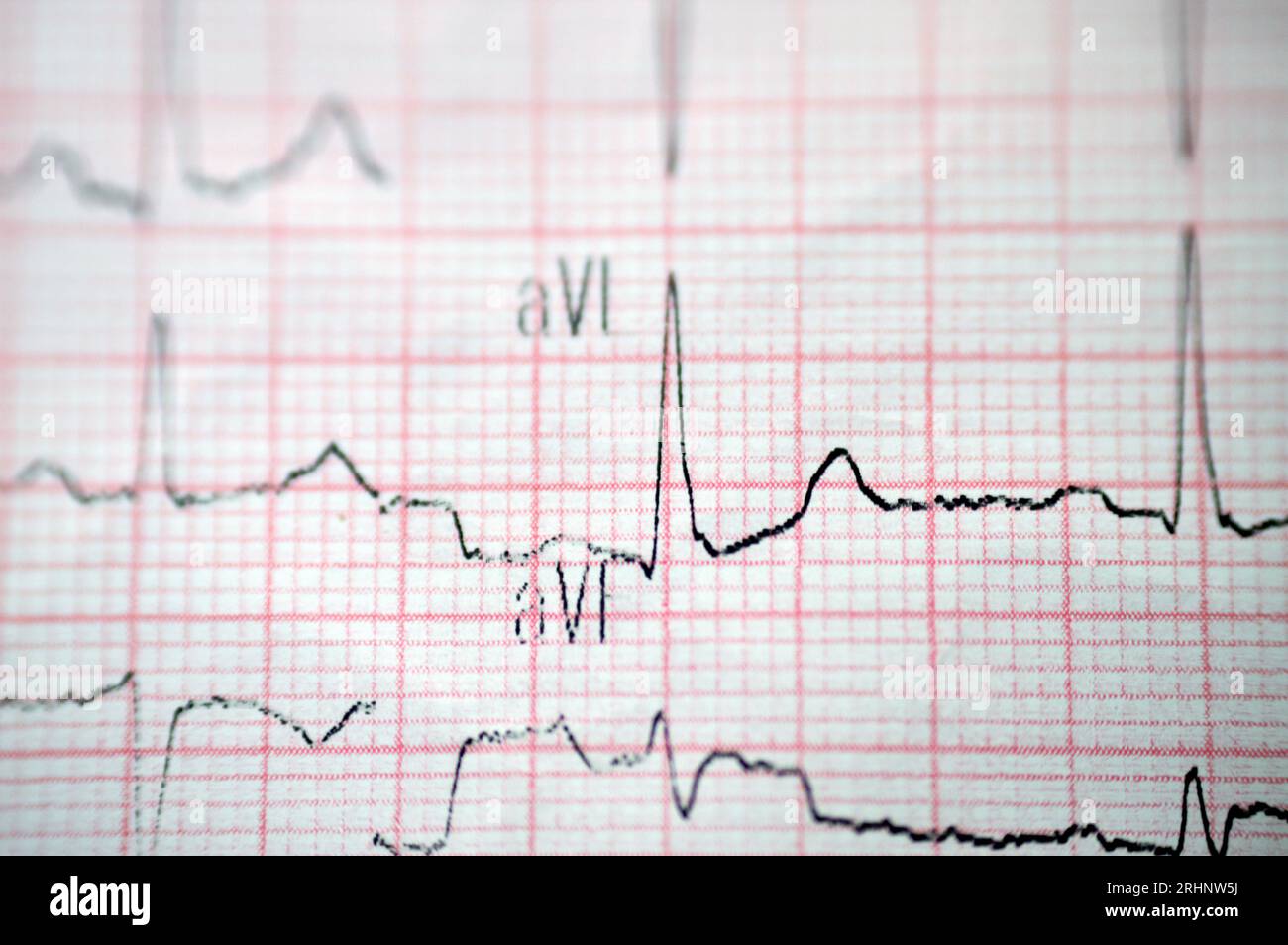 An ElectroCardioGraph ECG, a chart that draws the electricity of the ...