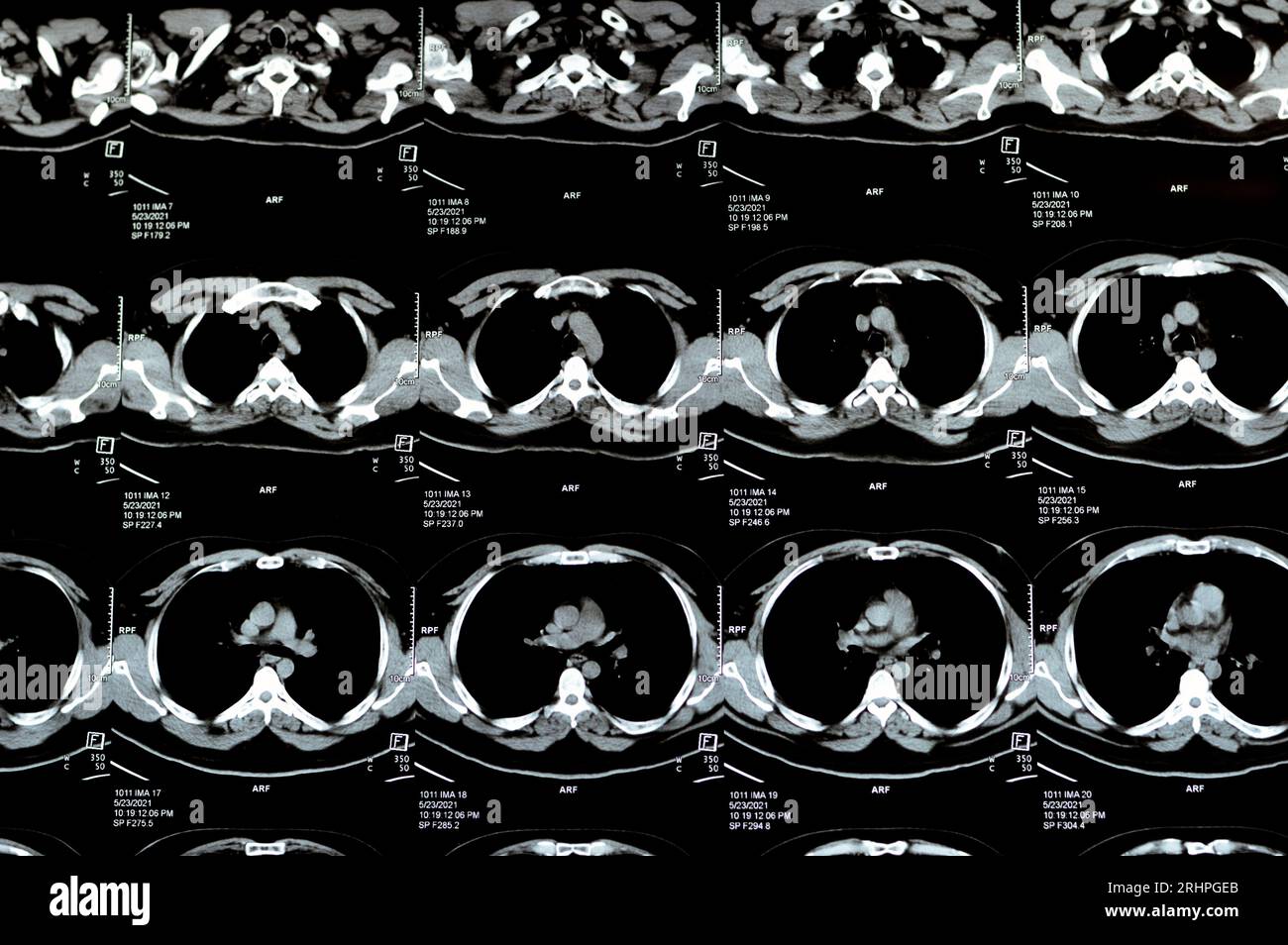 Multi slice CT scan of the chest showing normal study, normal ...