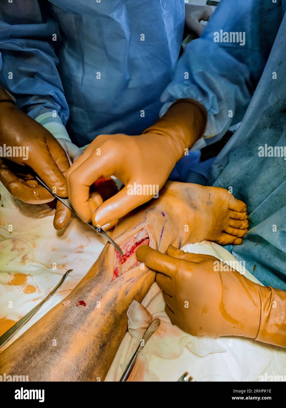When faced with leg fracture, surgeons opt for installation of metal plate during surgery. Stock Photo