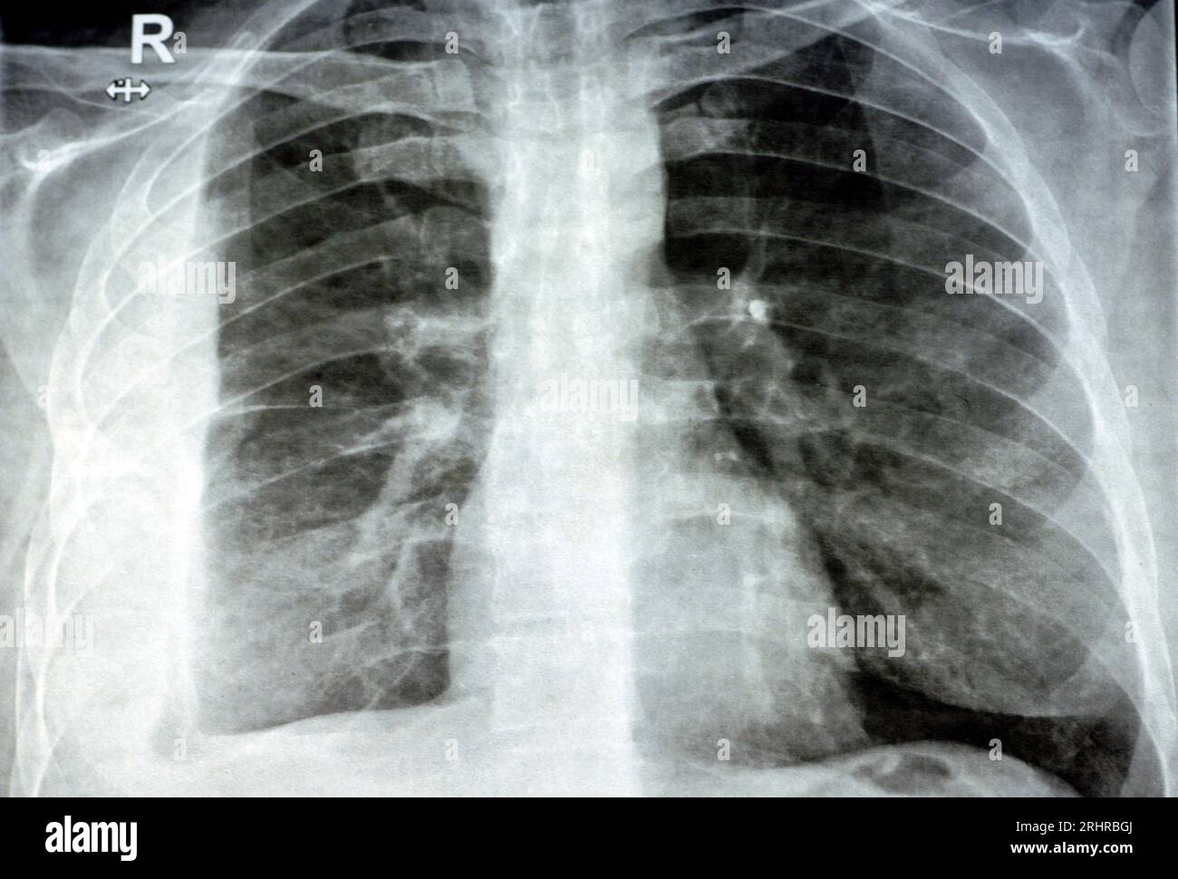 Plain X ray for a patient with aspiration pneumonia right lung, empyema, pleural effusion after insertion of a chest thoracostomy tube to drain the pu Stock Photo