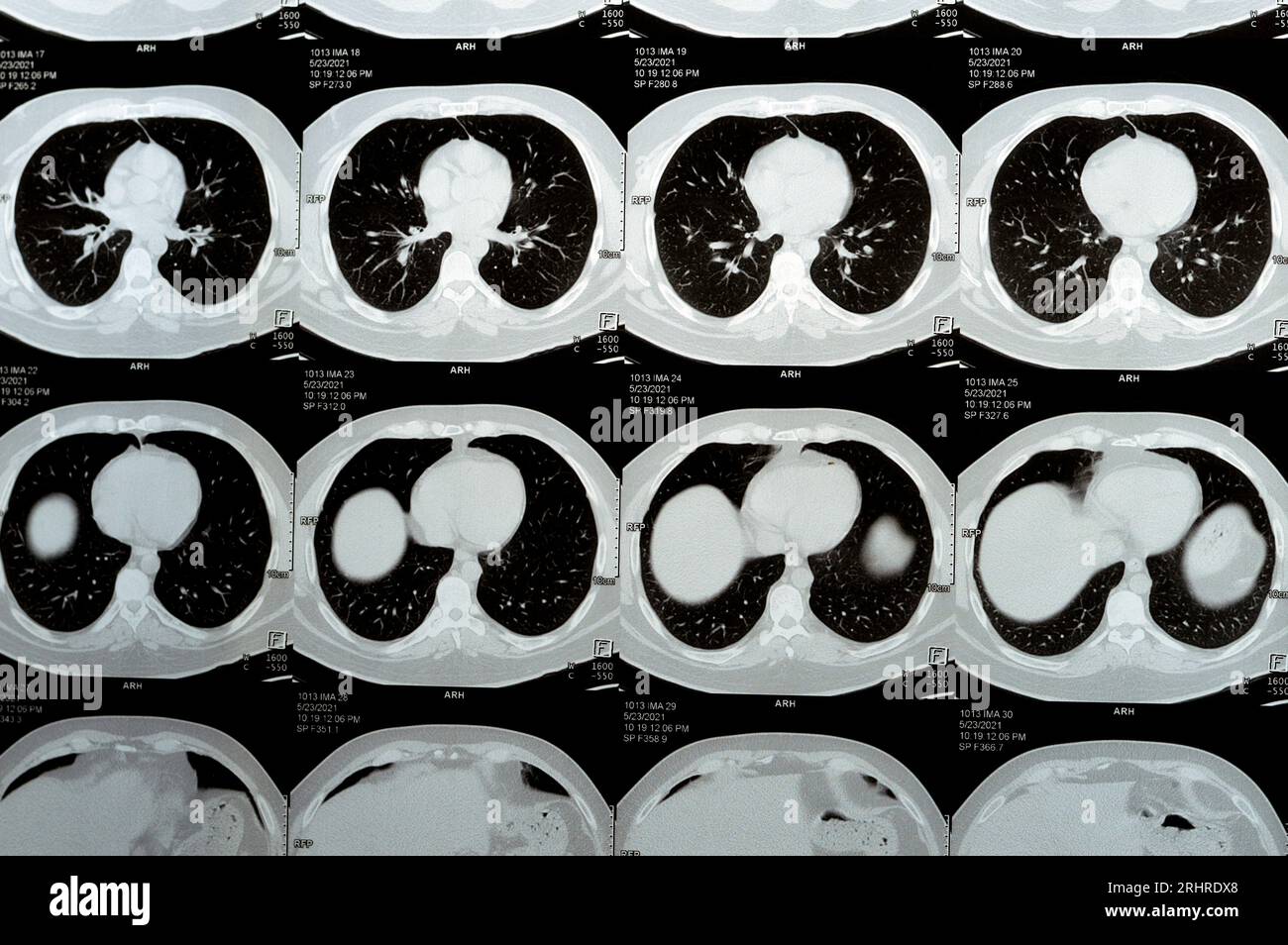 Multi slice CT scan of the chest showing normal study, normal appearance of the lungs
