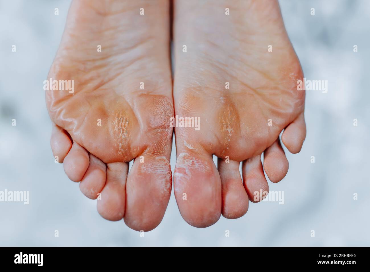 Unkempt woman feet, woman feet without pedicure Stock Photo