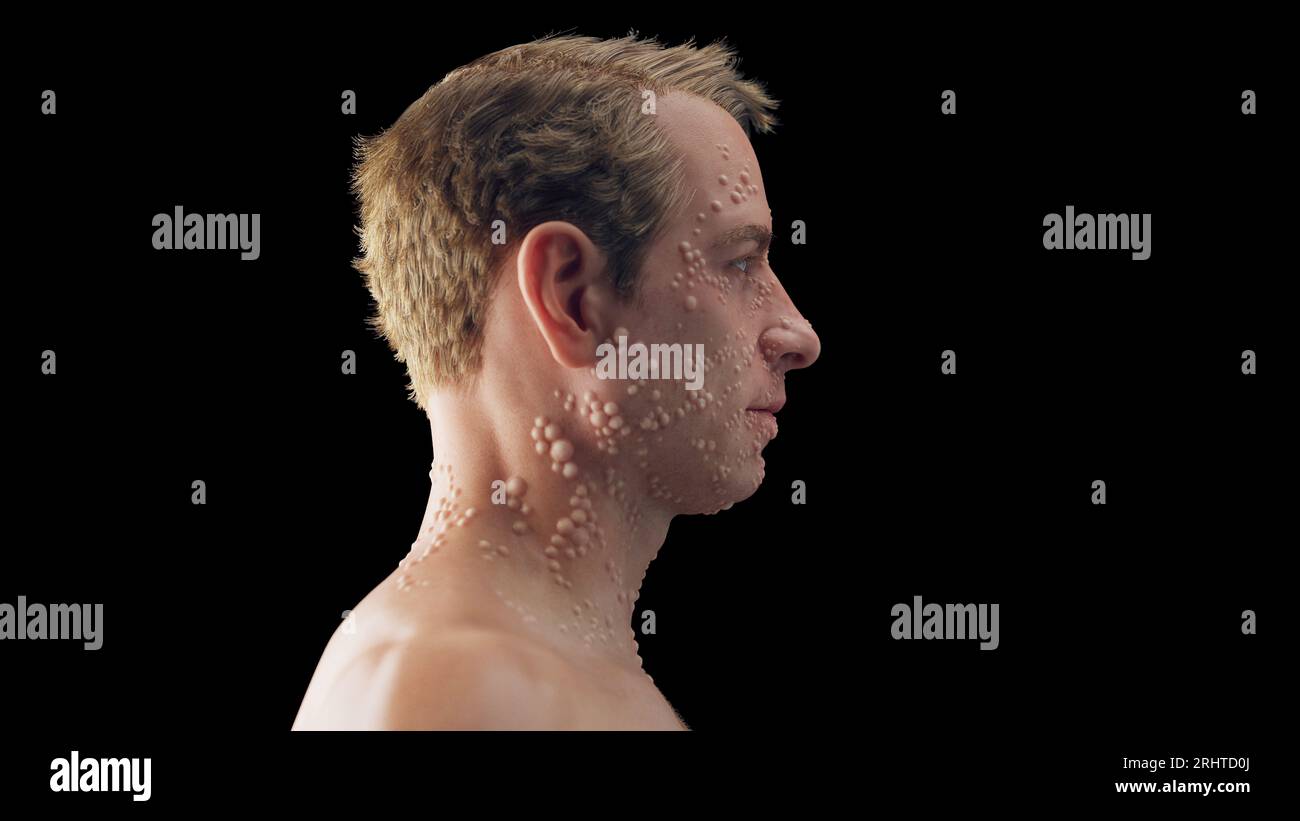 Smallpox Rash Distribution On Body Man infected with smallpox hi-res stock photography and images - Alamy