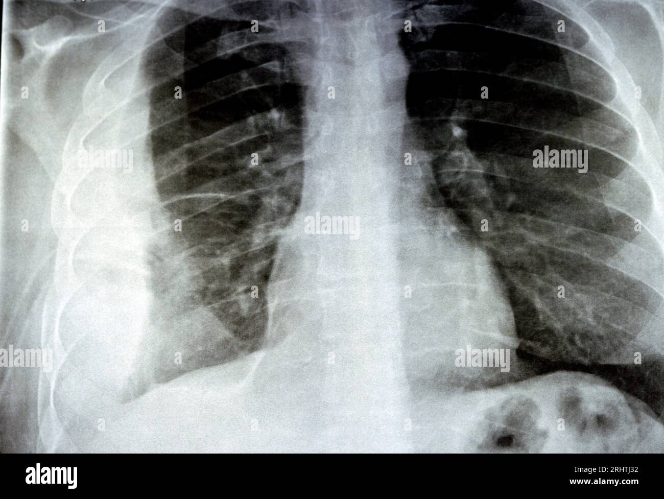 Plain X ray for a patient with aspiration pneumonia right lung, empyema
