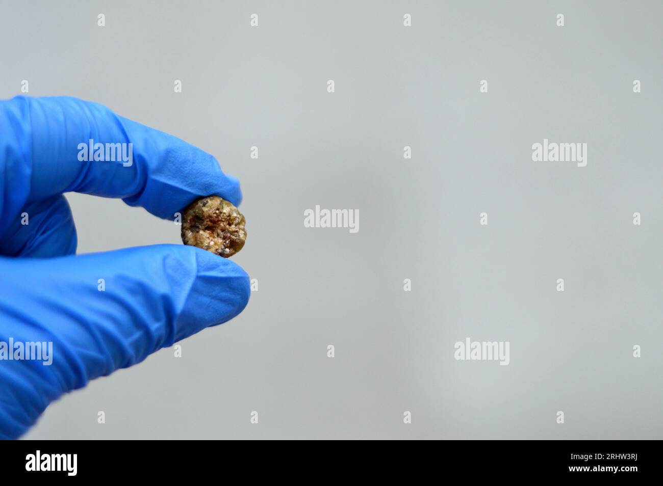 Large gallstone removed surgically after laparoscopic cholecystectomy