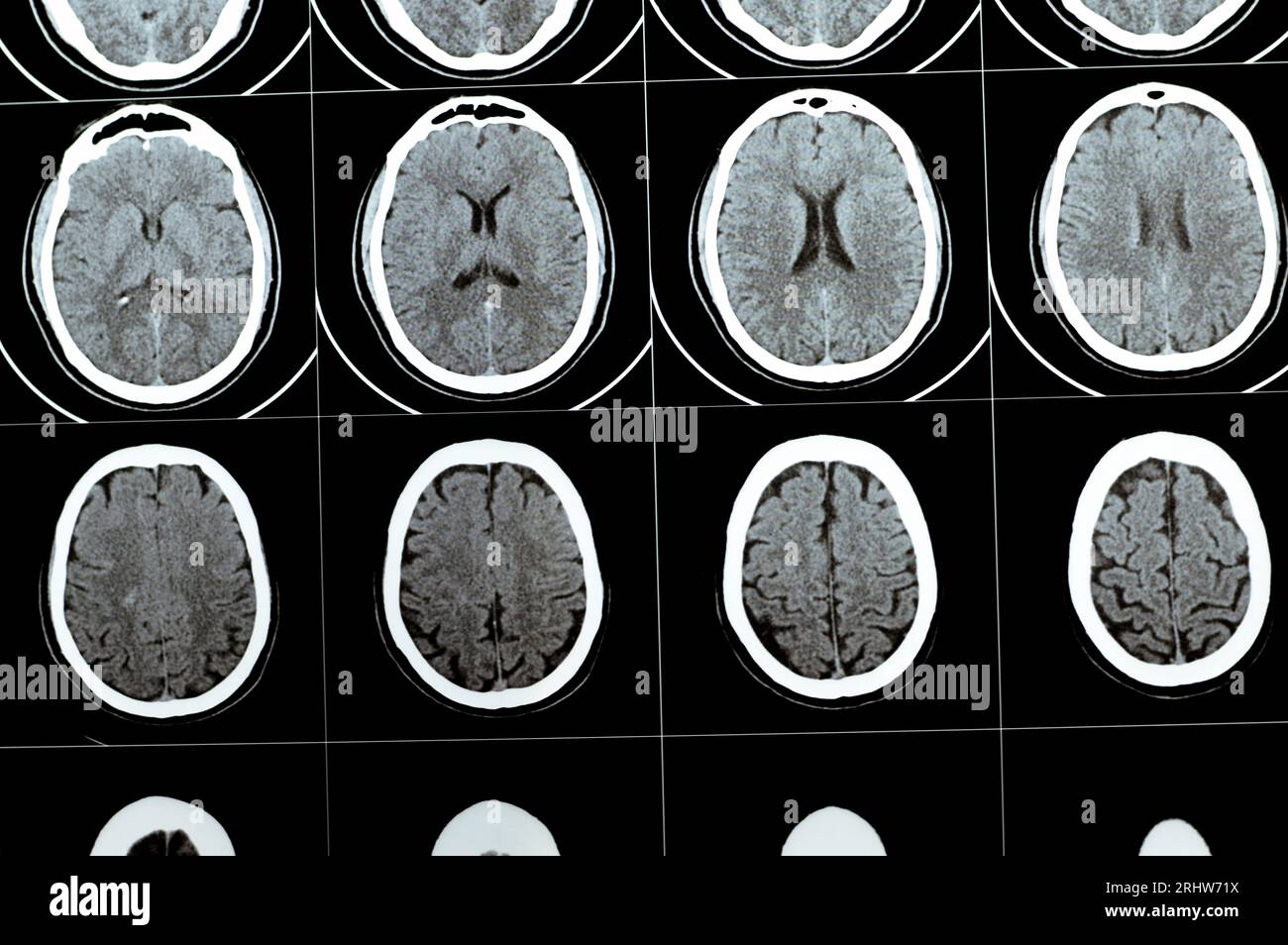 Multi slice CT scan of the brain showing Large brain stem and right