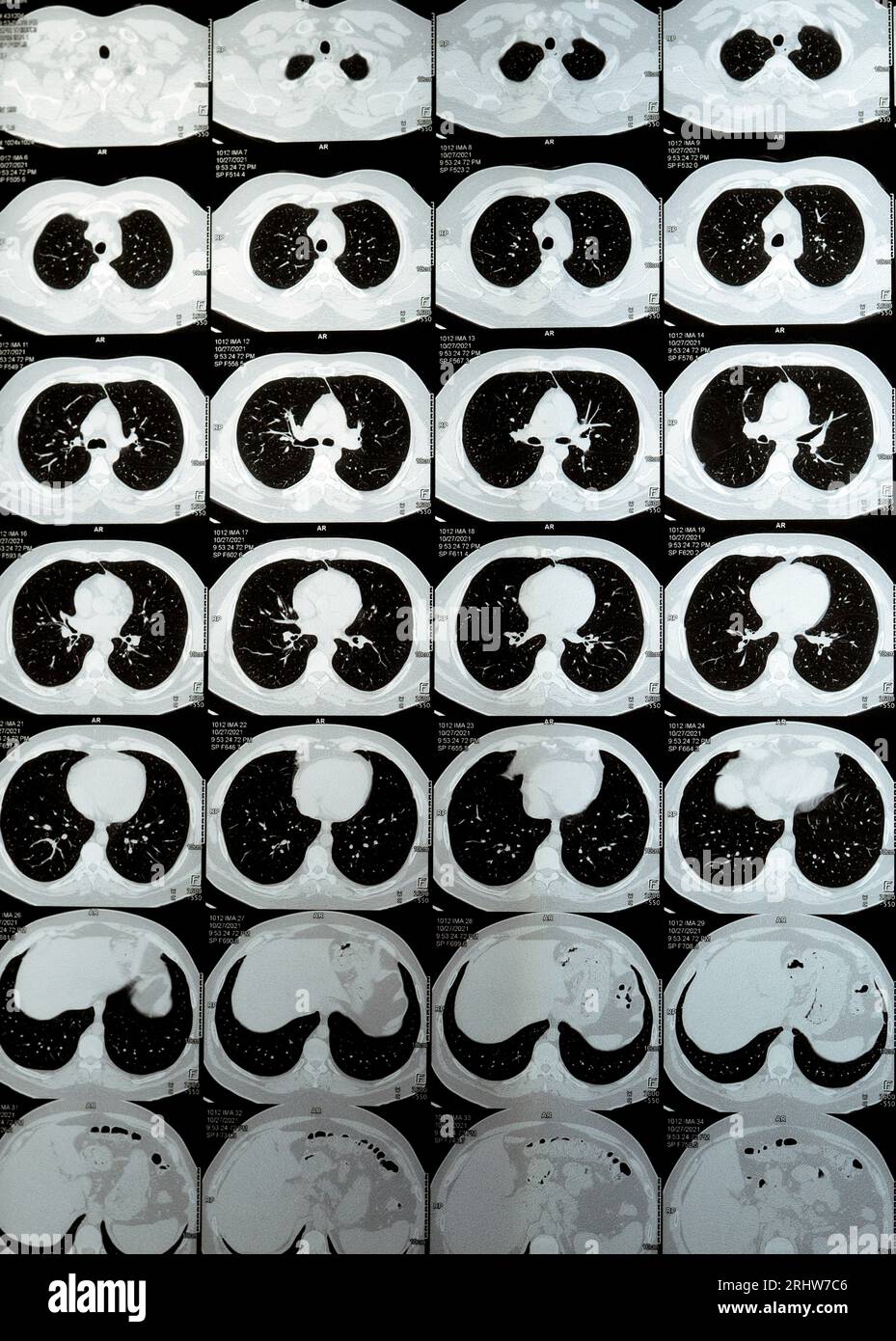 Multi slice CT scan of the chest showing normal study, normal appearance of the lungs, parenchyma, pulmonary vasculature,  mediastinal structures, no Stock Photo