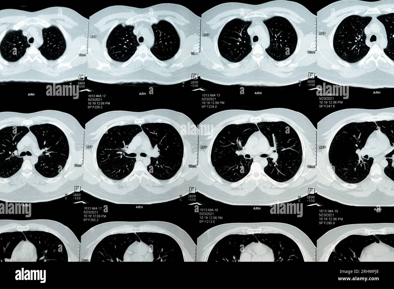 Multi slice CT scan of the chest showing normal study, normal ...