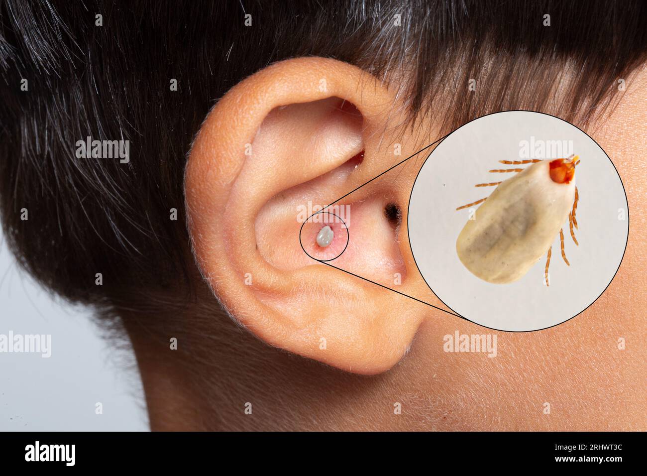 Blood sucking tick, attached to the ear of a human child. Concept of