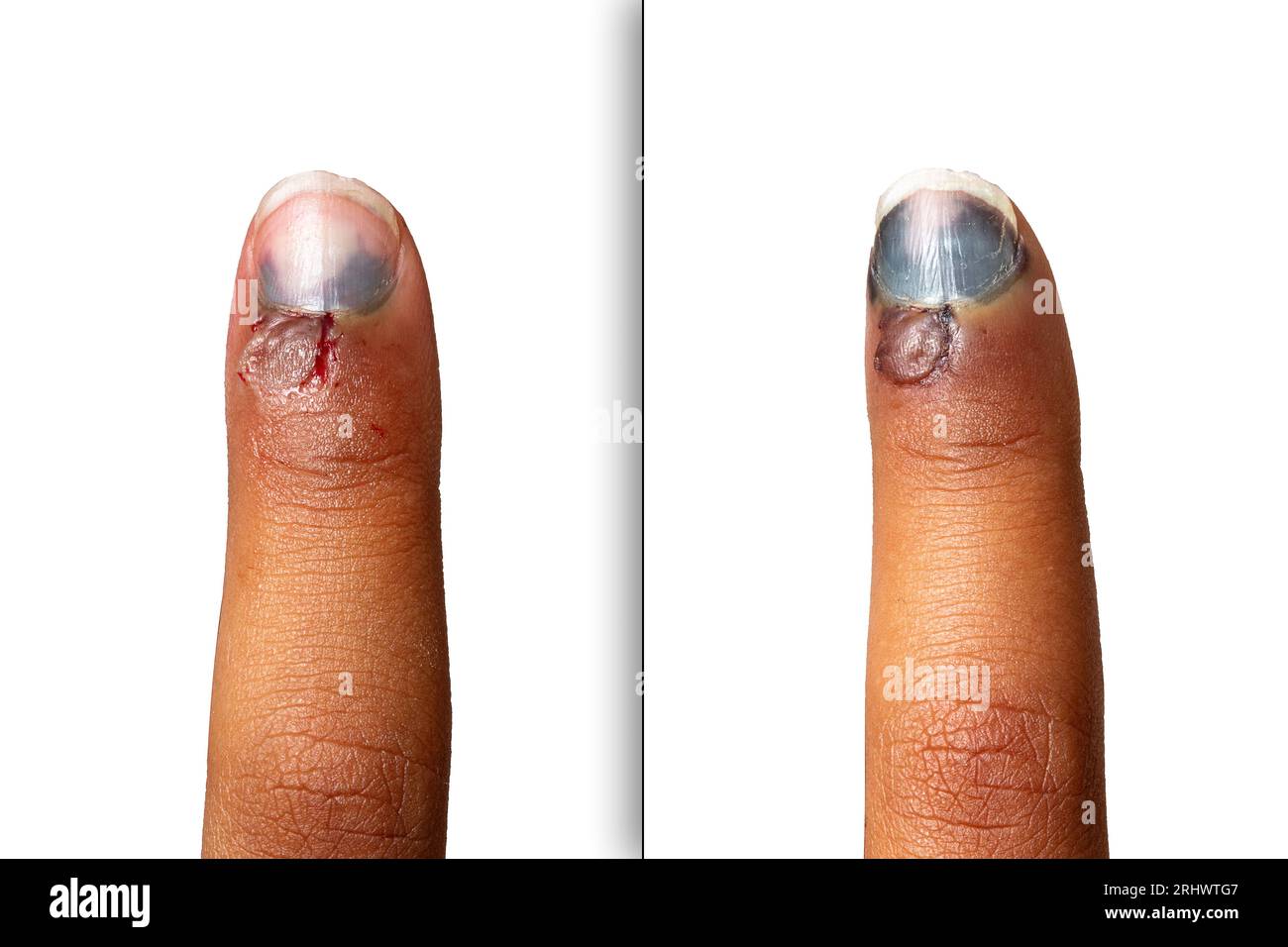 Evolution after a few days of the hematoma of a crushed finger, collage of before and after the development of the black nail Stock Photo