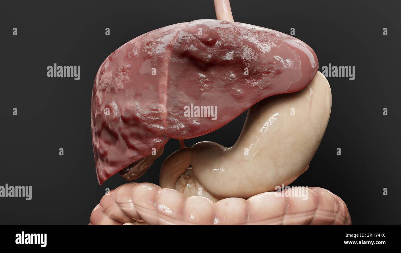 Digestive Organ Liver Cancer, Hepatitis cirrhosis malignant tumor, Hepatic failure, growing cells, duplicating, Fibrosis, Cirrhosis, Hepatocellular ca Stock Photo