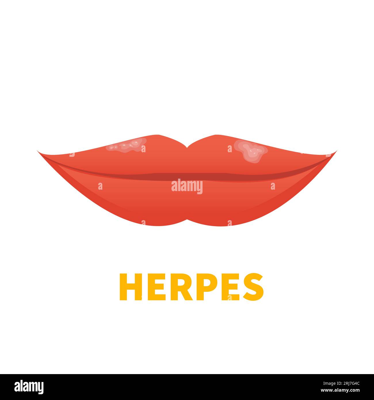 Herpes HSV cold sore lip outbreak medical icon Stock Vector