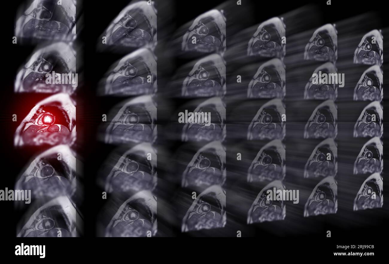 MRI heart or Cardiac MRI ( magnetic resonance imaging ) of heart for ...