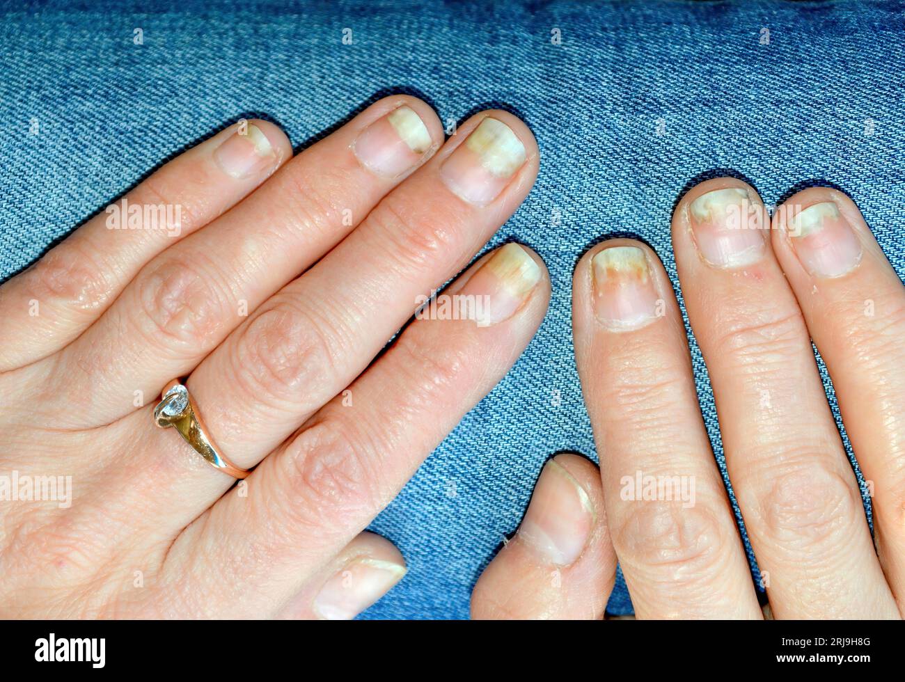 Fungal nail infection, onycholysis after shellac or gel-varnish Stock Photo