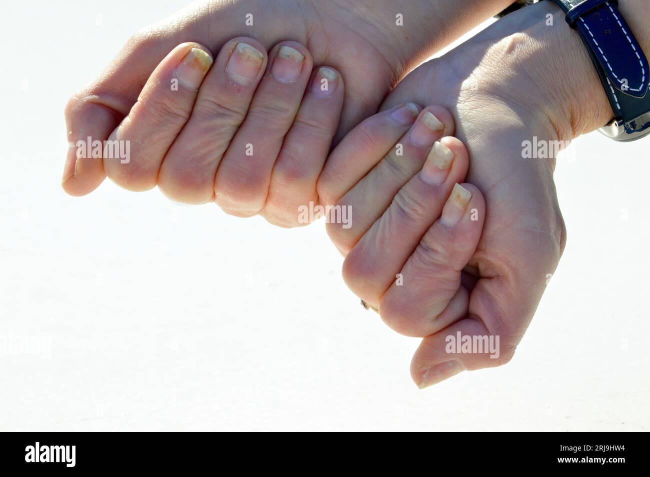 Fungal nail infection, onycholysis after shellac or gel-varnish Stock Photo