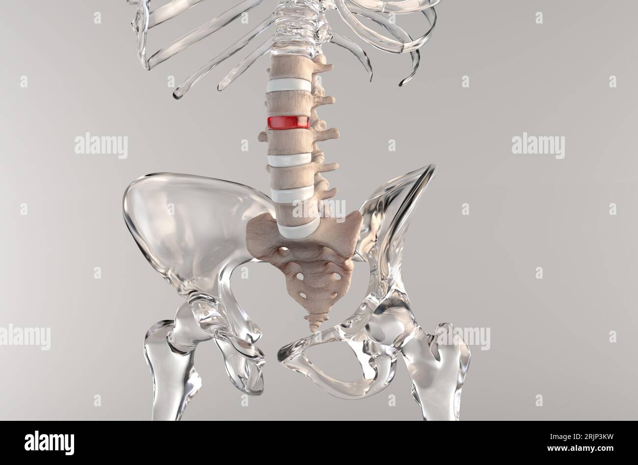 3D medical illustration of a human skeleton suffering stenosis in the lumbar spine region Stock Photo