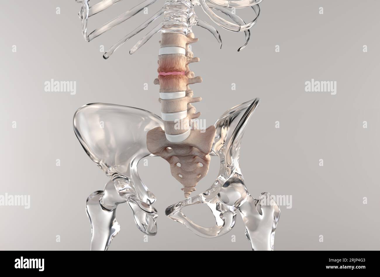 3D medical illustration of a human skeleton suffering stenosis in the lumbar spine region Stock Photo