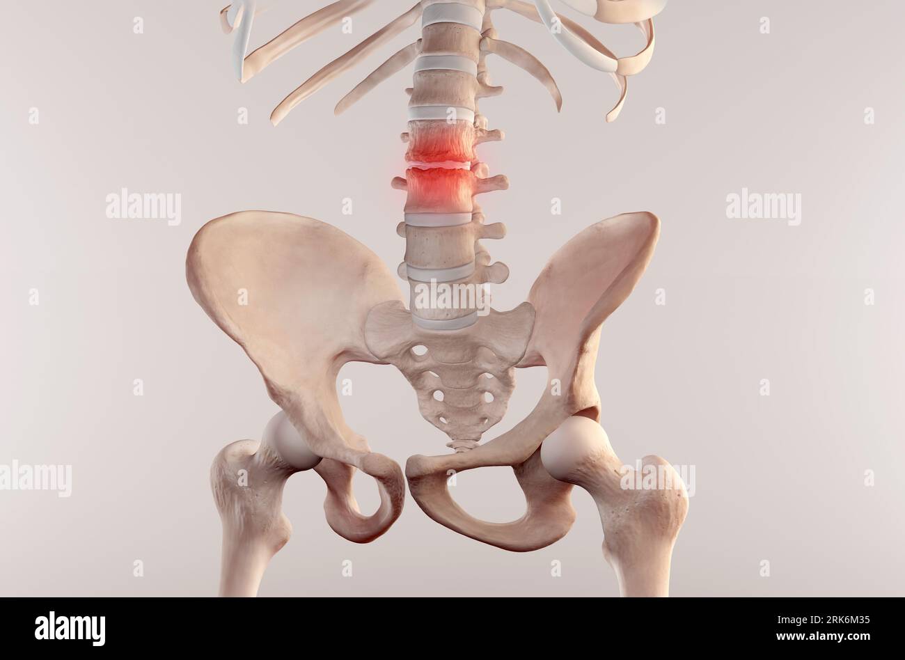 3D medical illustration of a human skeleton suffering stenosis in the lumbar spine region Stock Photo