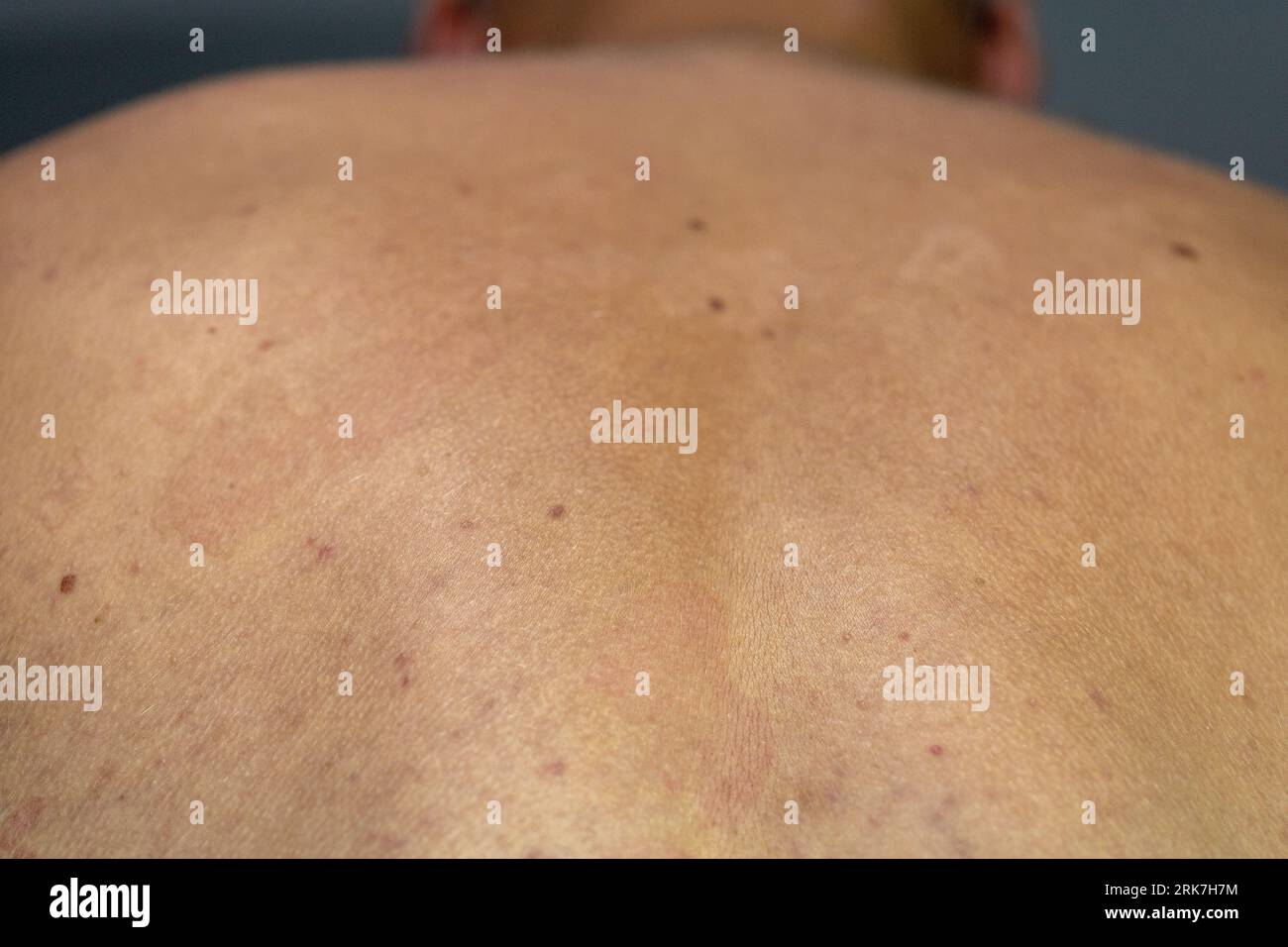 A man suffering from the skin condition Tinea Versicolor with discolored patches on the skin