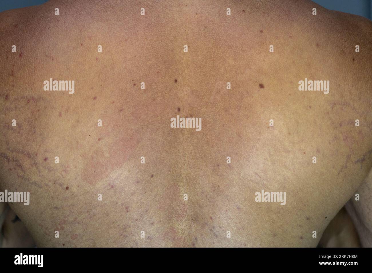 A man suffering from the skin condition Tinea Versicolor with discolored patches on the skin