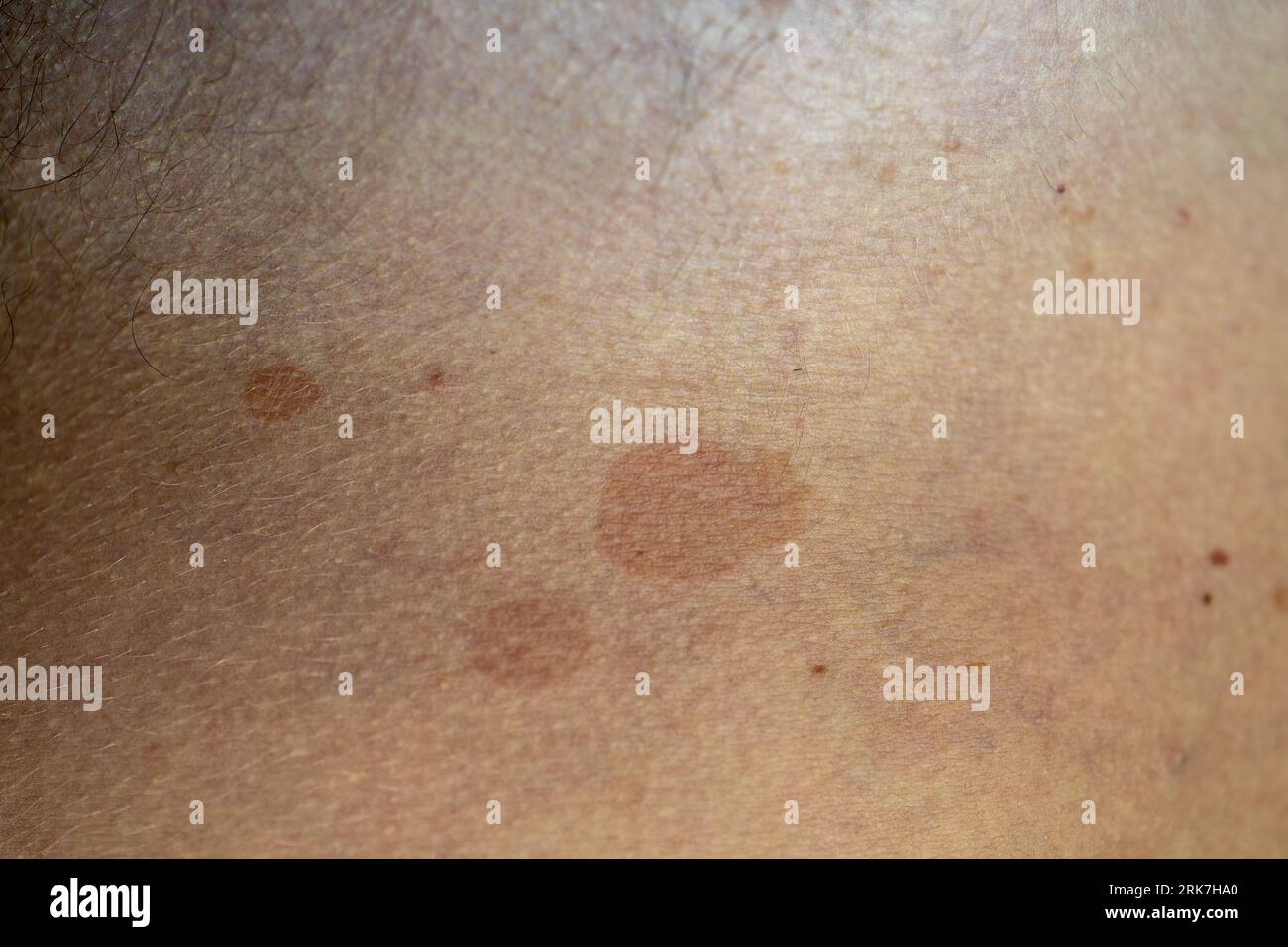 A man suffering from the skin condition Tinea Versicolor with