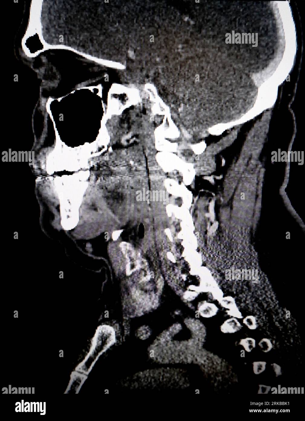 Xray of spinal cord hi-res stock photography and images - Alamy