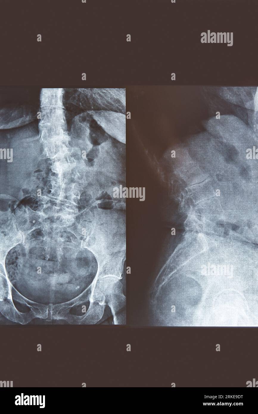 Lumbar spine xray. Front and lateral view. Healthcare. Image diagnosis