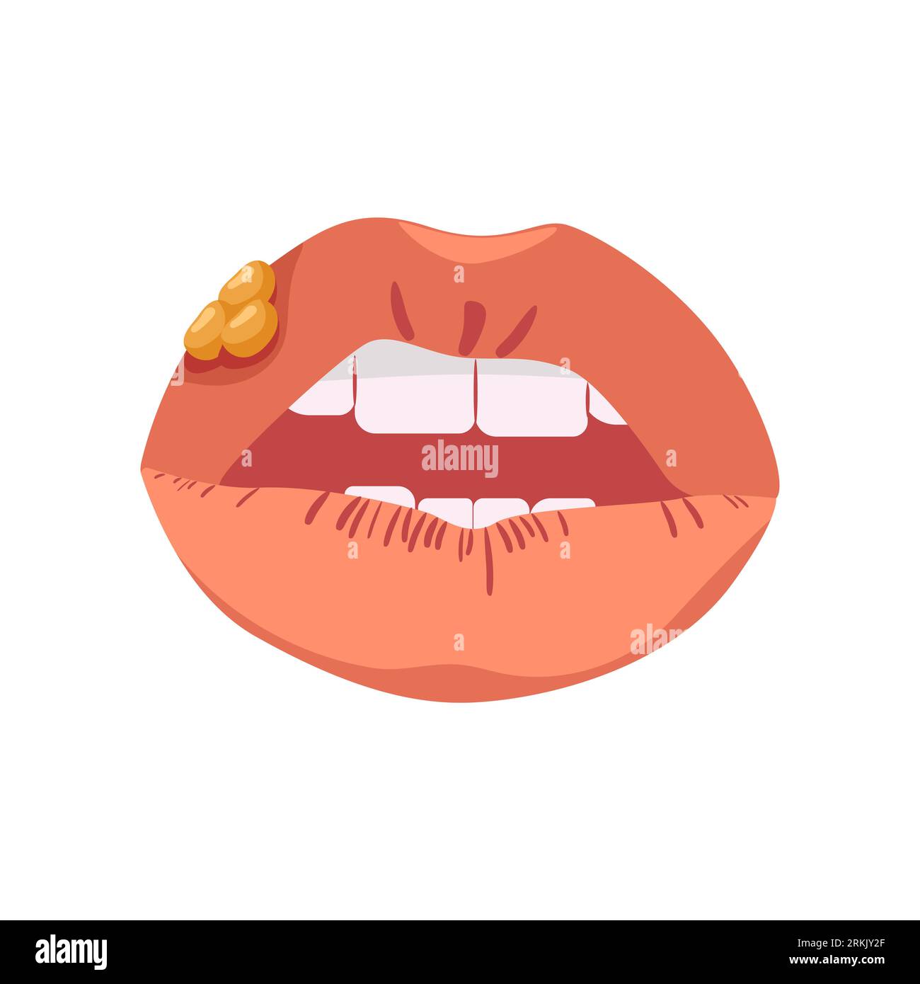 Lips with herpes. Infectious disease affecting mucous membranes Stock
