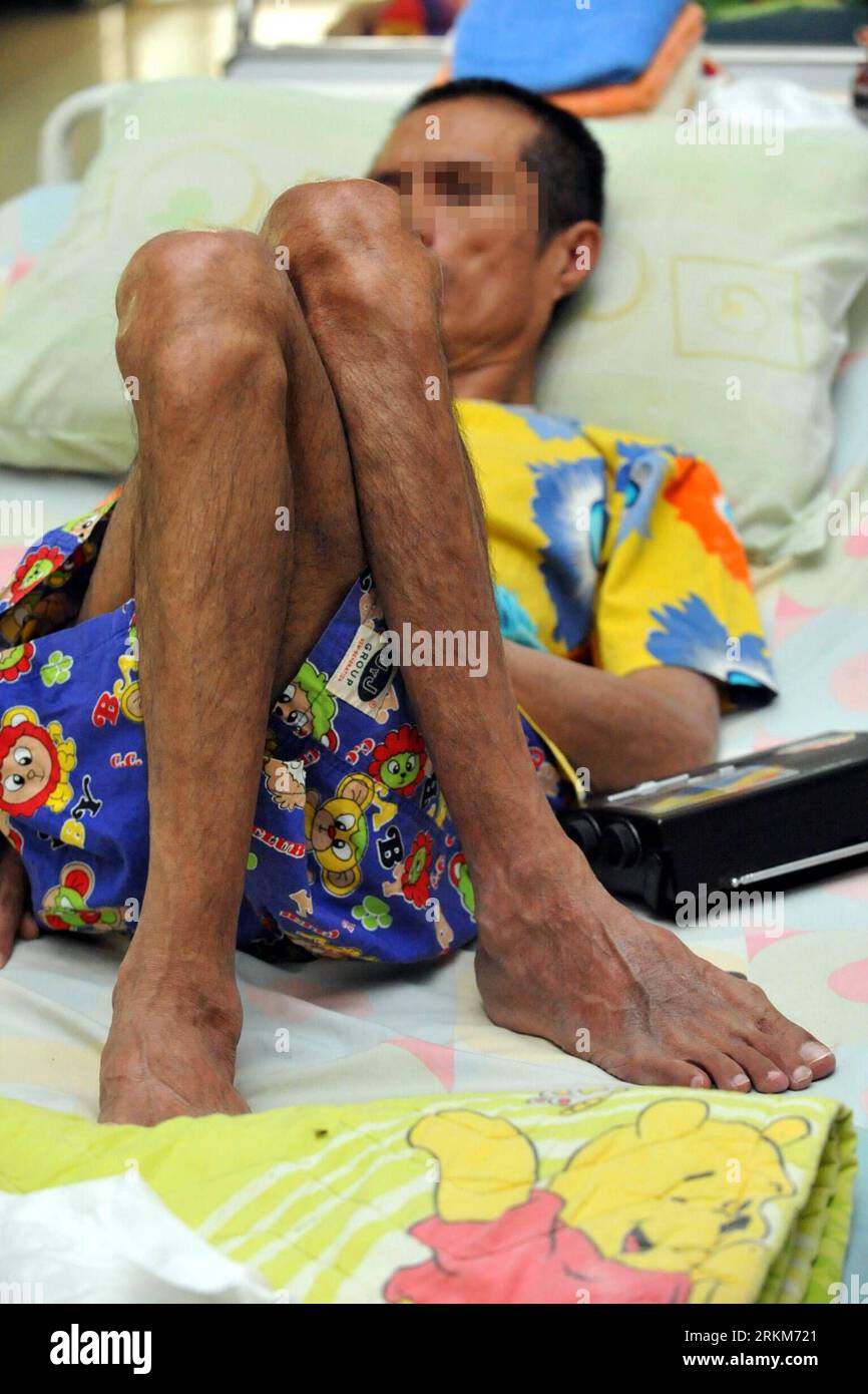 Hiv patient stage hi-res stock photography and images - Alamy