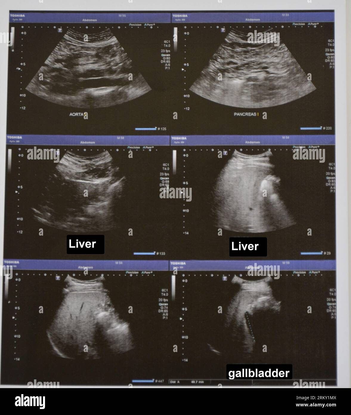Ultrasonography of the upper abdomen with visualized portions of the aorta, pancreas, liver and gallbladder Stock Photo