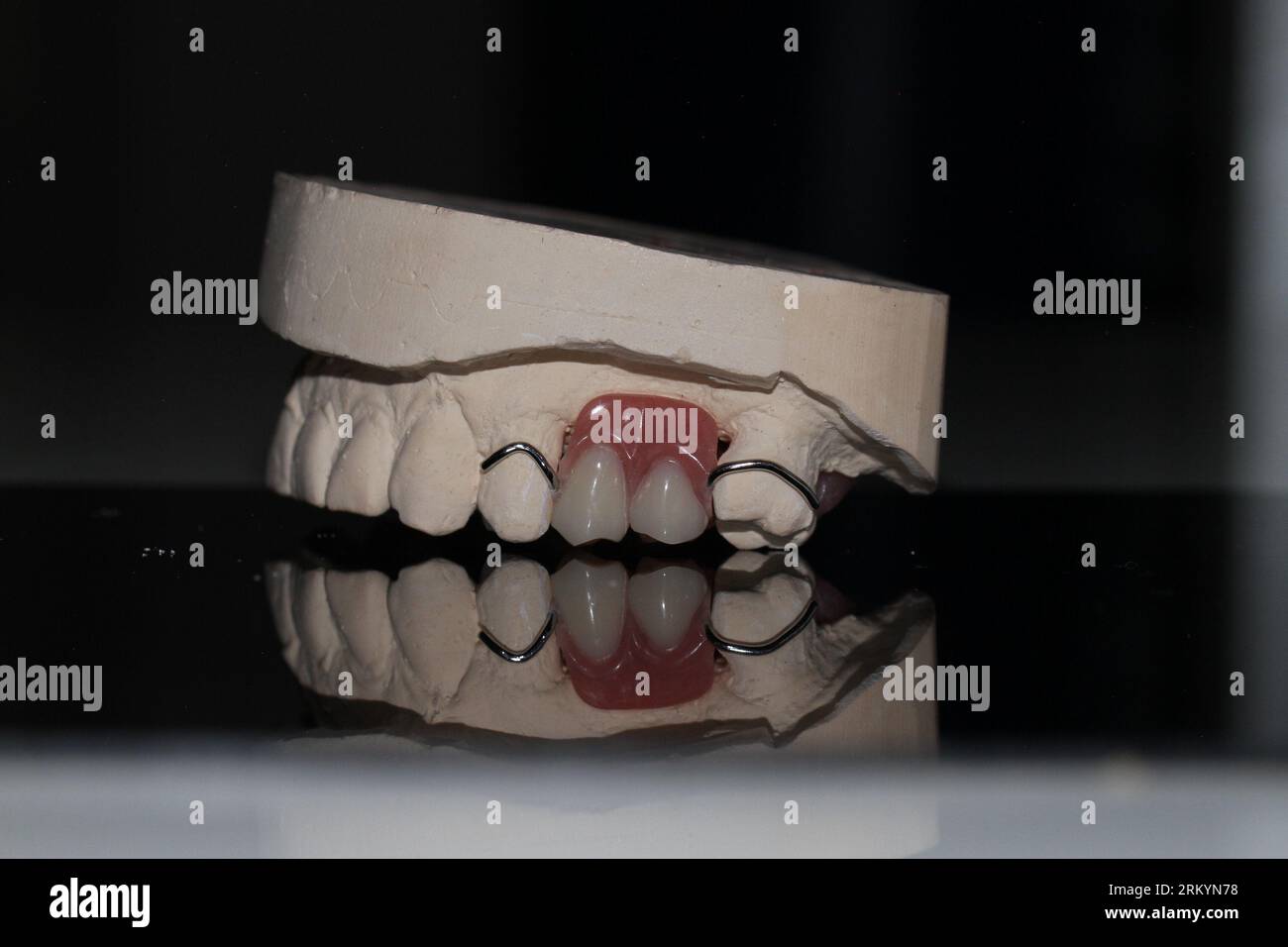 dental technician model removable prosthesis PAPM cobalt chrome resin ...