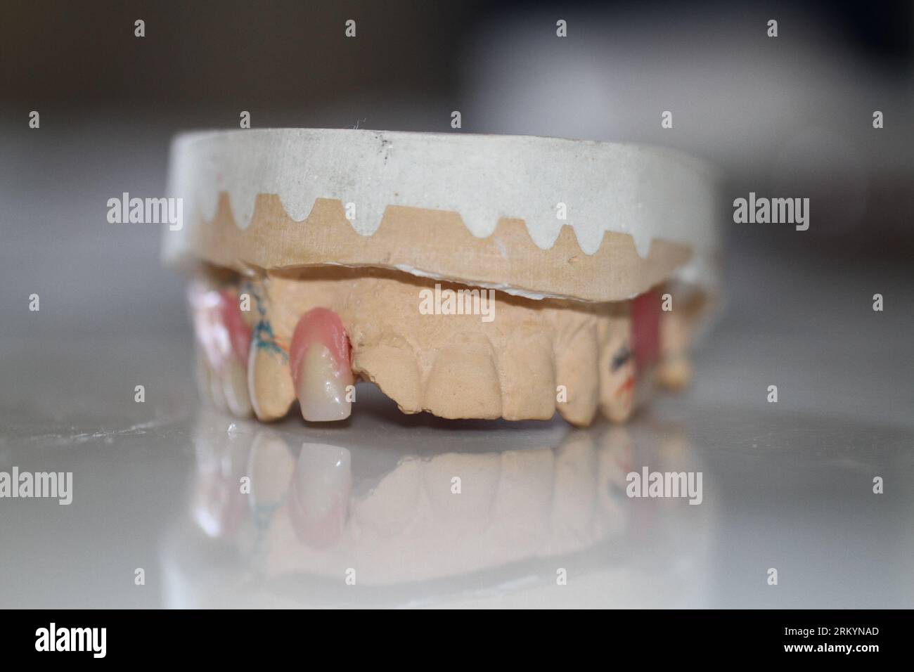 dental technician model removable prosthesis PAPM cobalt chrome resin ...