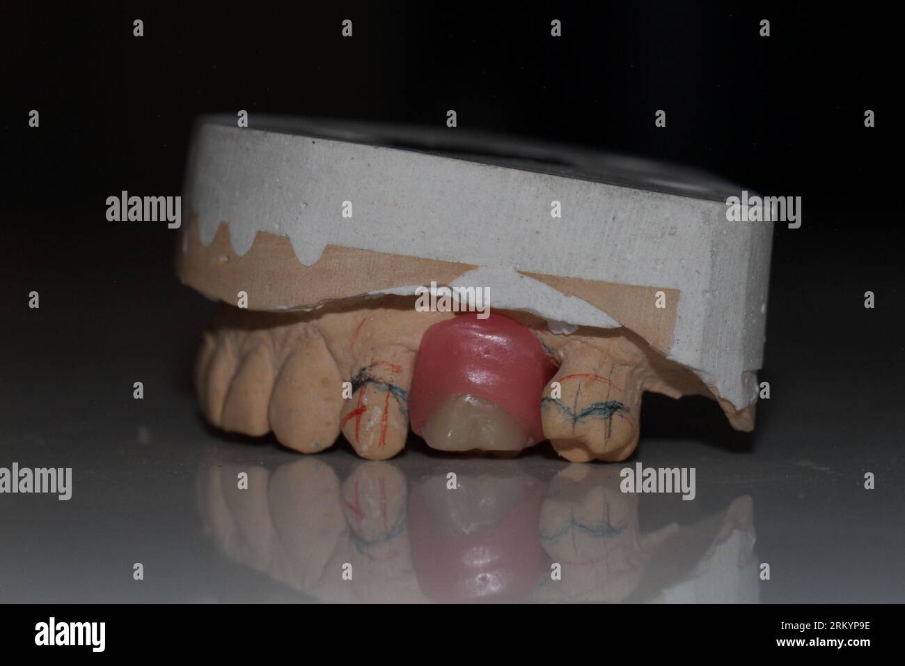 dental technician model removable prosthesis PAPM cobalt chrome resin ...