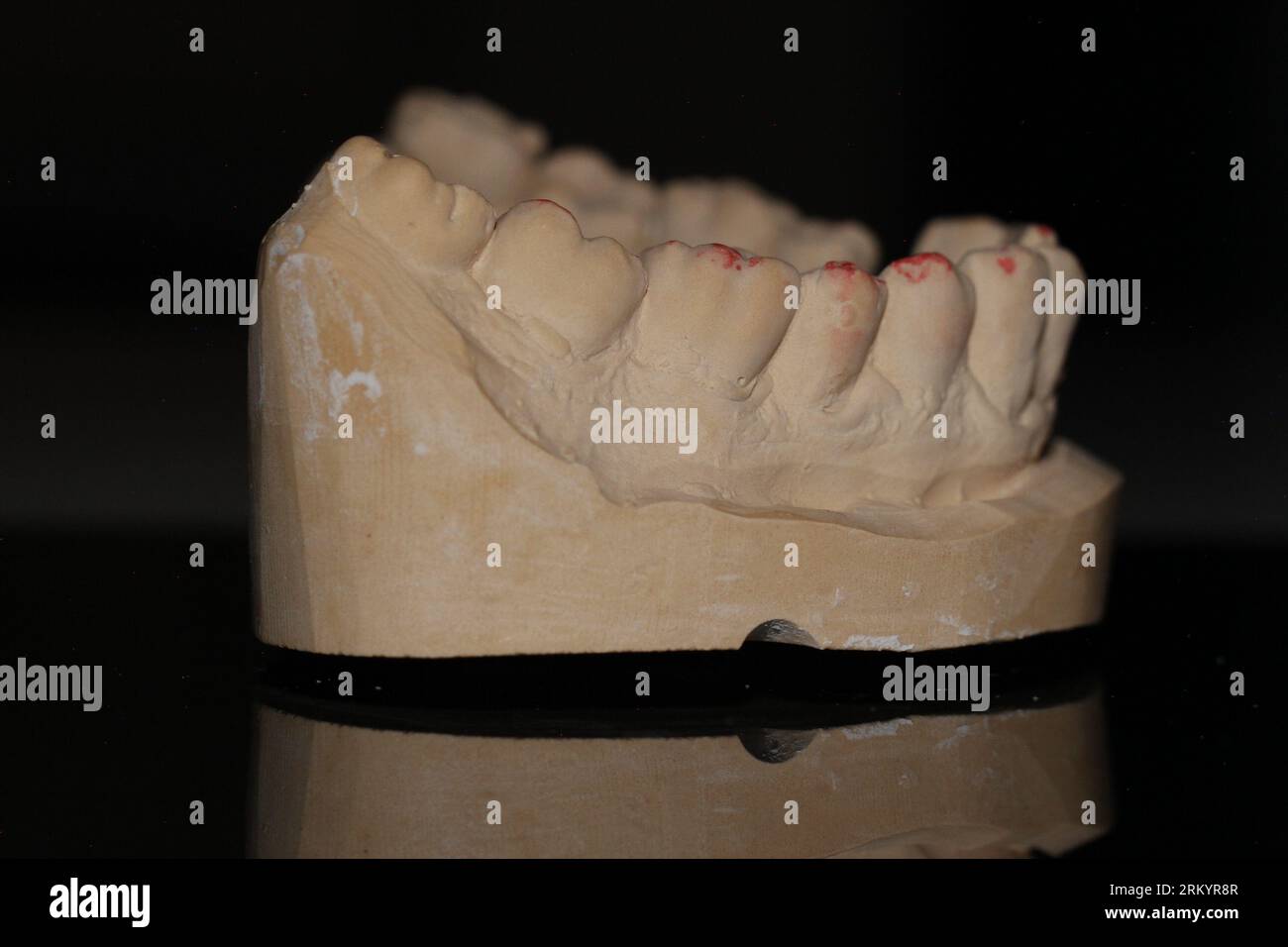 dental technician model removable prosthesis PAPM cobalt chrome resin ...