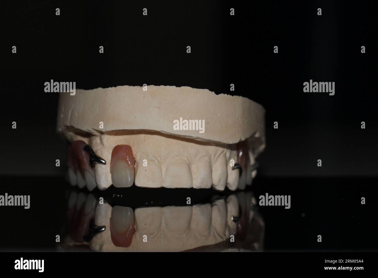 dental technician model removable prosthesis PAPM cobalt chrome resin ...
