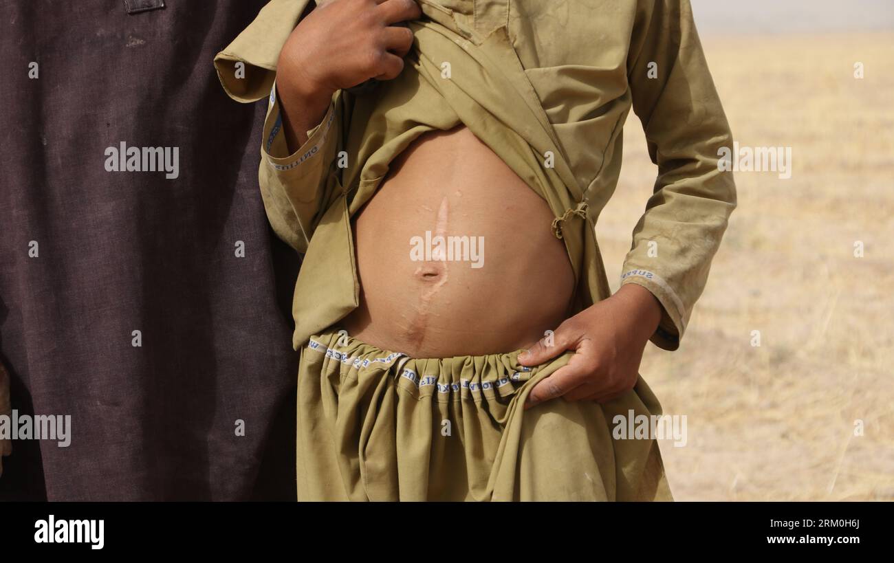 Farah, Afghanistan. 26th July, 2023. A boy shows his belly hurt by a blast of unexploded ordnance left by U.S. forces in Farah Province, Afghanistan, July 26, 2023. TO GO WITH 'Feature: U.S.-left unexploded ordnance still claiming lives of Afghans' Credit: Marshal/Xinhua/Alamy Live News Stock Photo