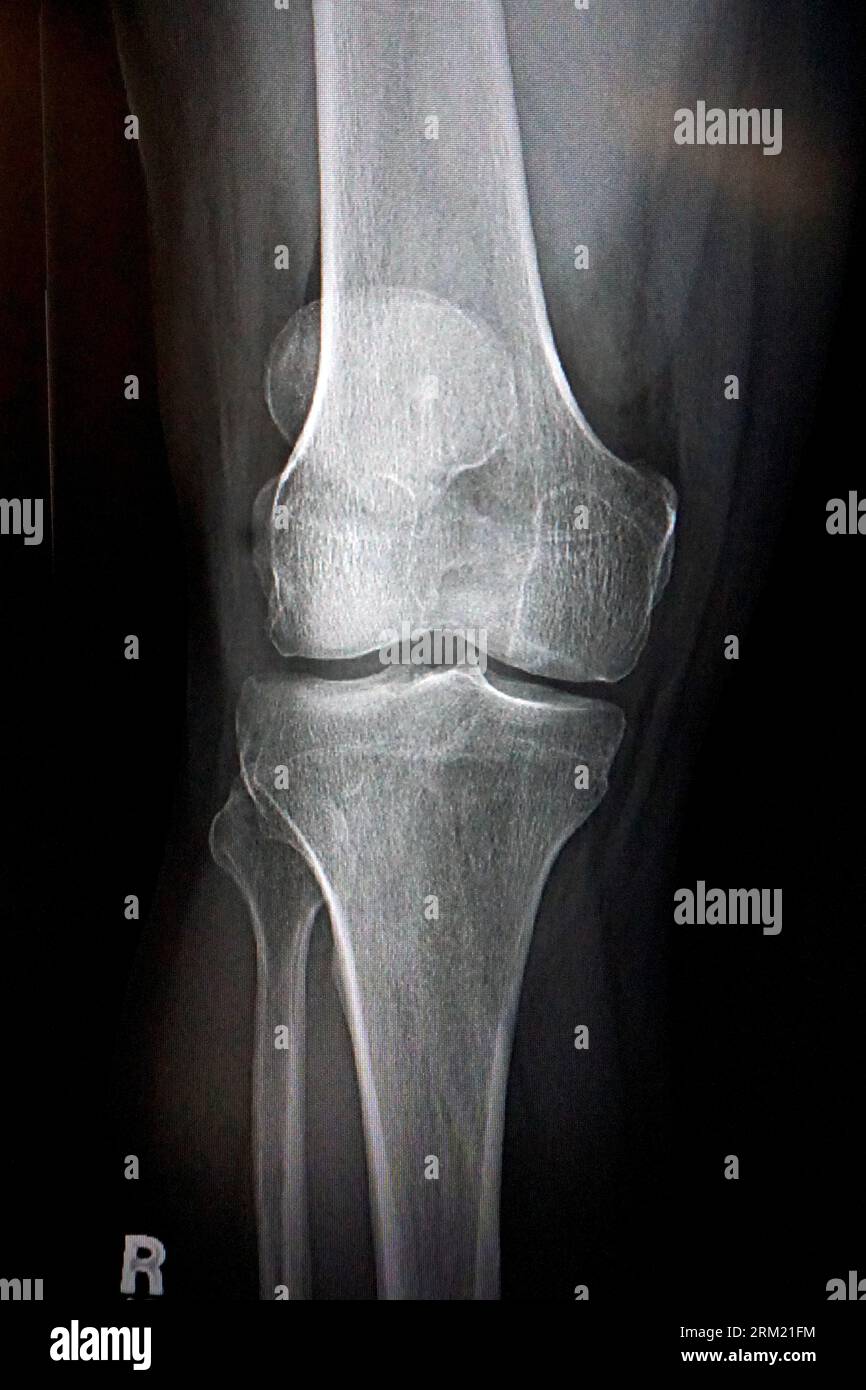 MRI image for orthopedics Stock Photo
