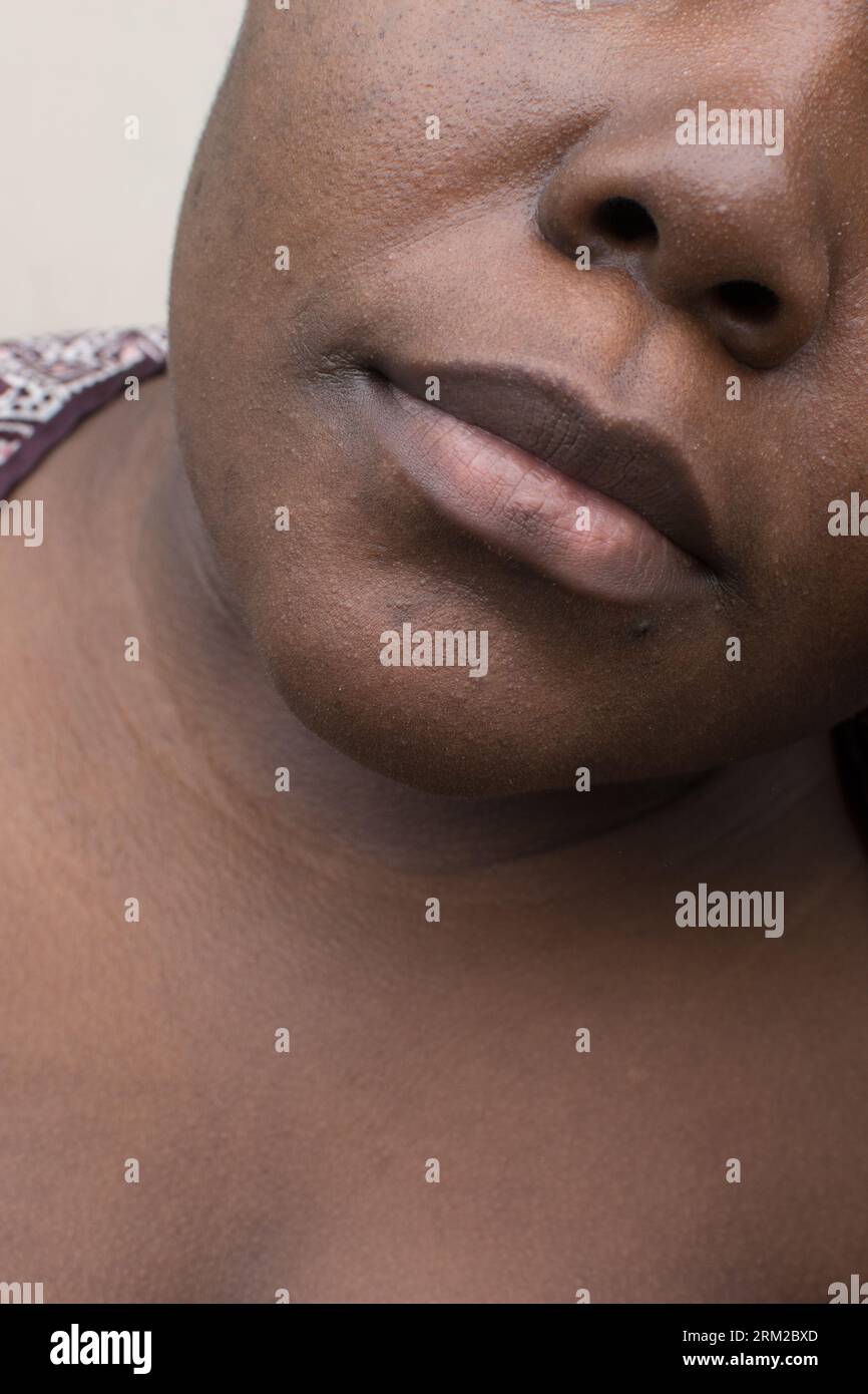 Brown skin with dark spots, hyperpigmentation on brown skin, african american woman with skin blemishes, imperfect skin Stock Photo